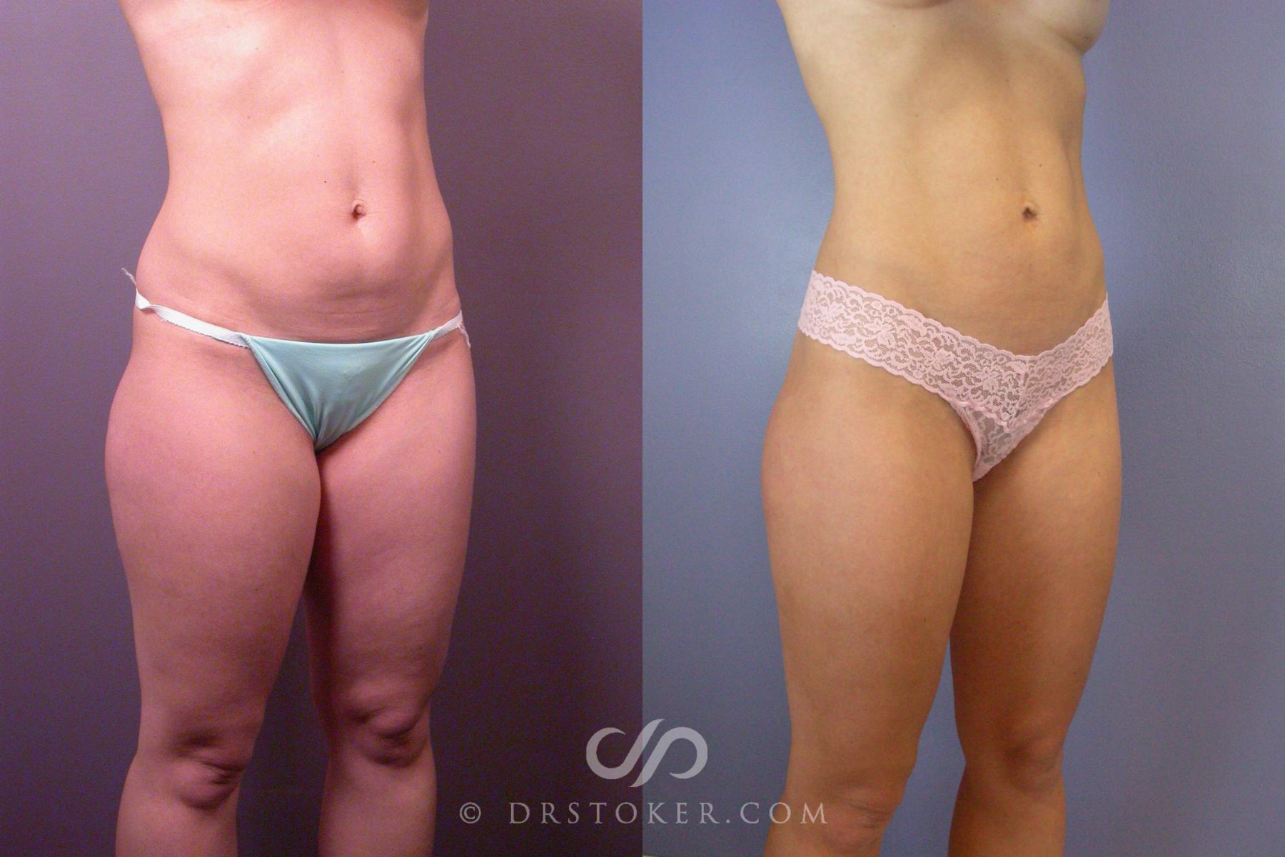 Before & After Liposuction Case 393 View #4 View in Los Angeles, CA