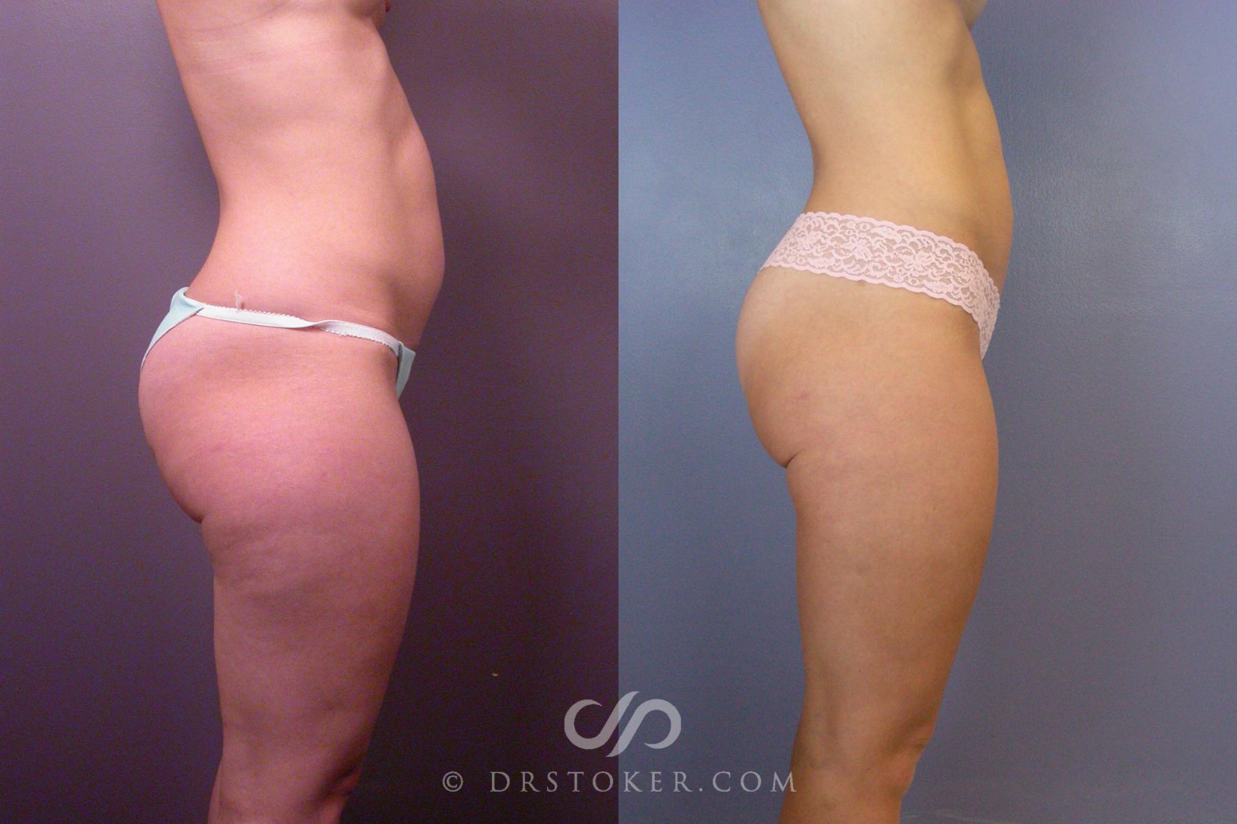 Before & After Liposuction Case 393 View #5 View in Los Angeles, CA