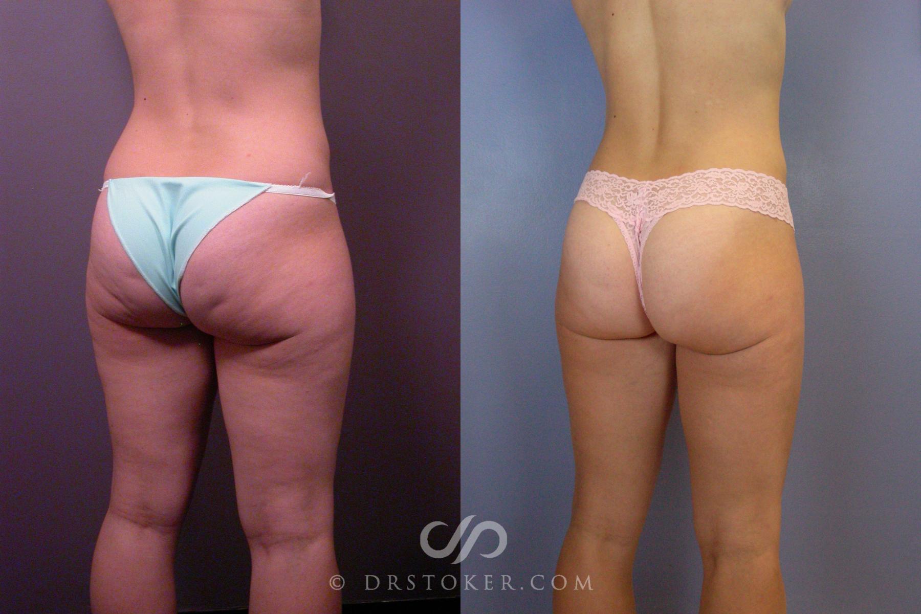 Before & After Liposuction Case 393 View #6 View in Los Angeles, CA