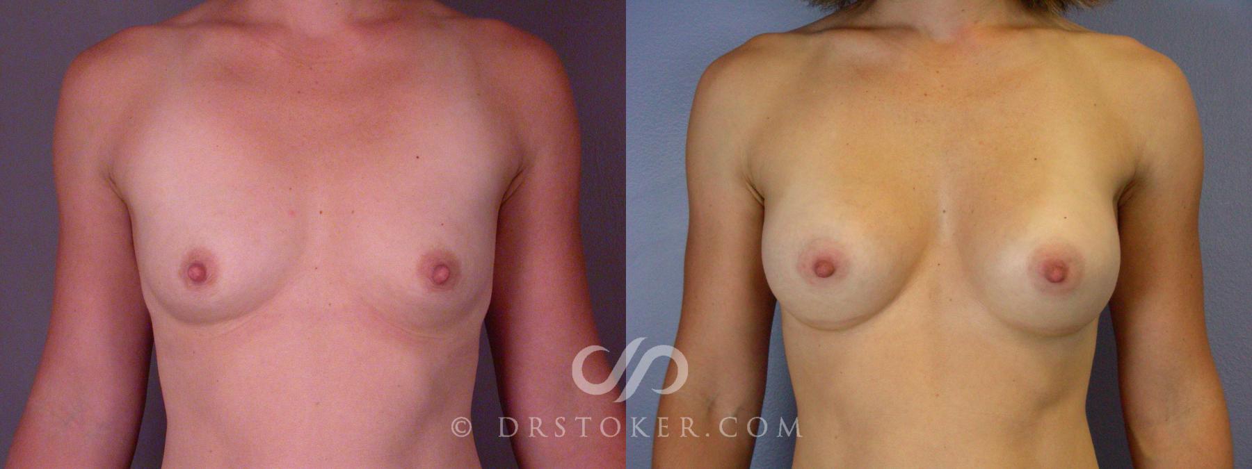 Before & After Liposuction Case 393 View #8 View in Los Angeles, CA