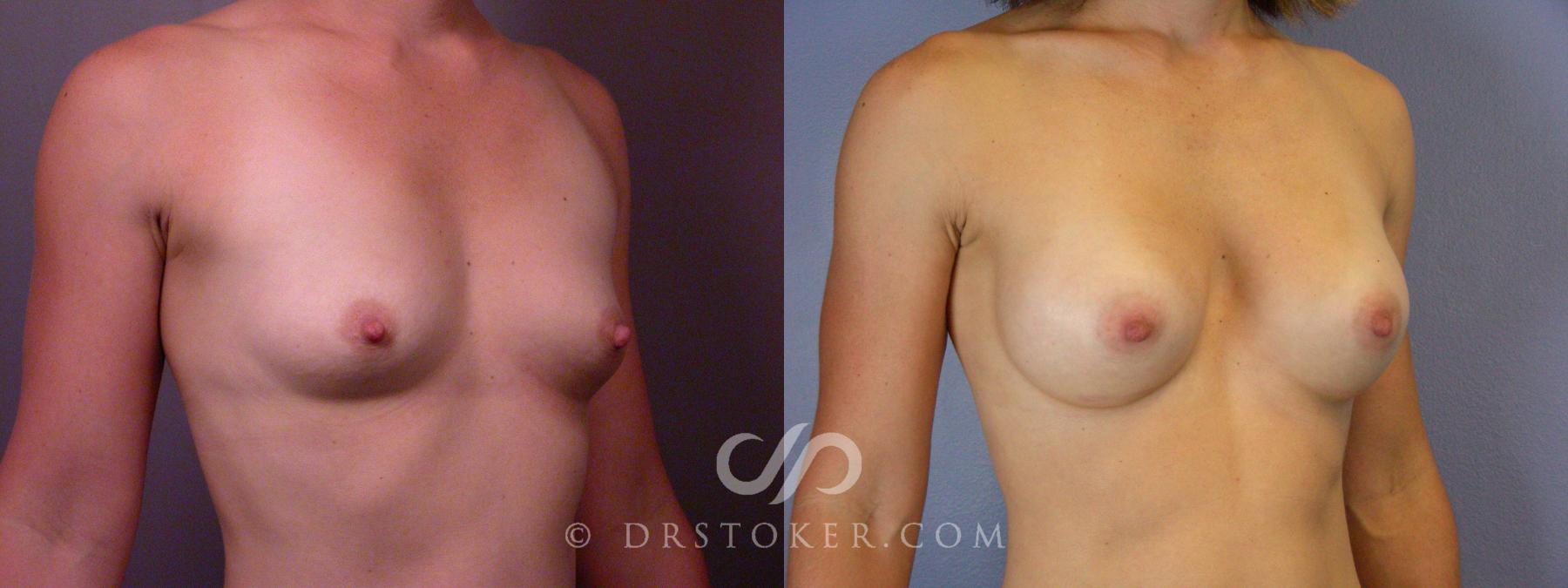 Before & After Liposuction Case 393 View #9 View in Los Angeles, CA