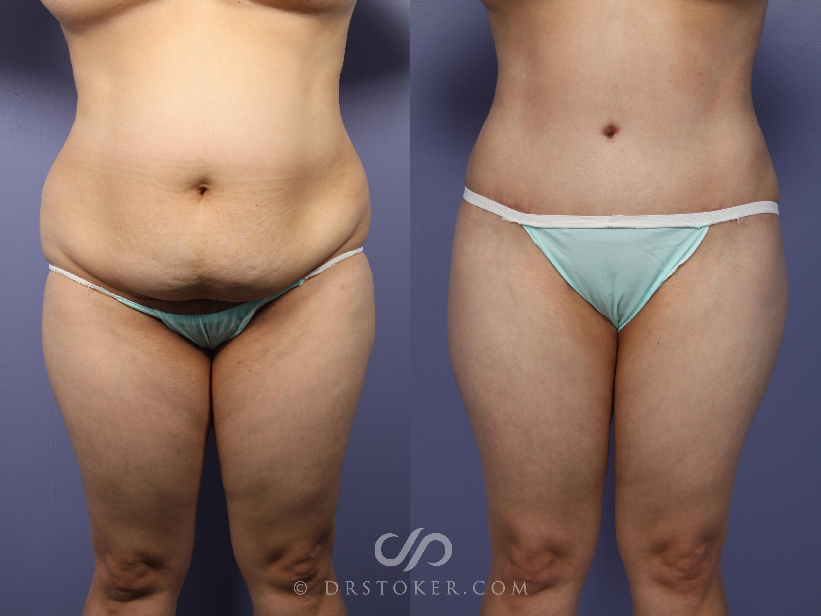Before & After Tummy Tuck Case 395 View #1 View in Los Angeles, CA