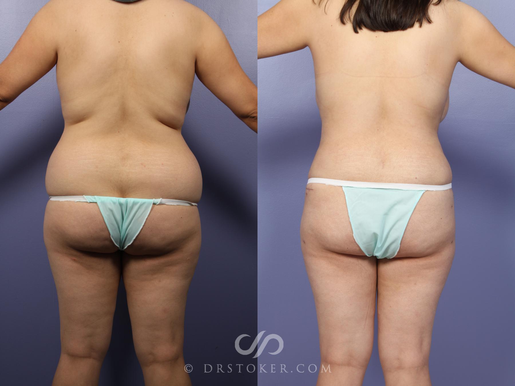 Before & After Tummy Tuck Case 395 View #2 View in Los Angeles, CA