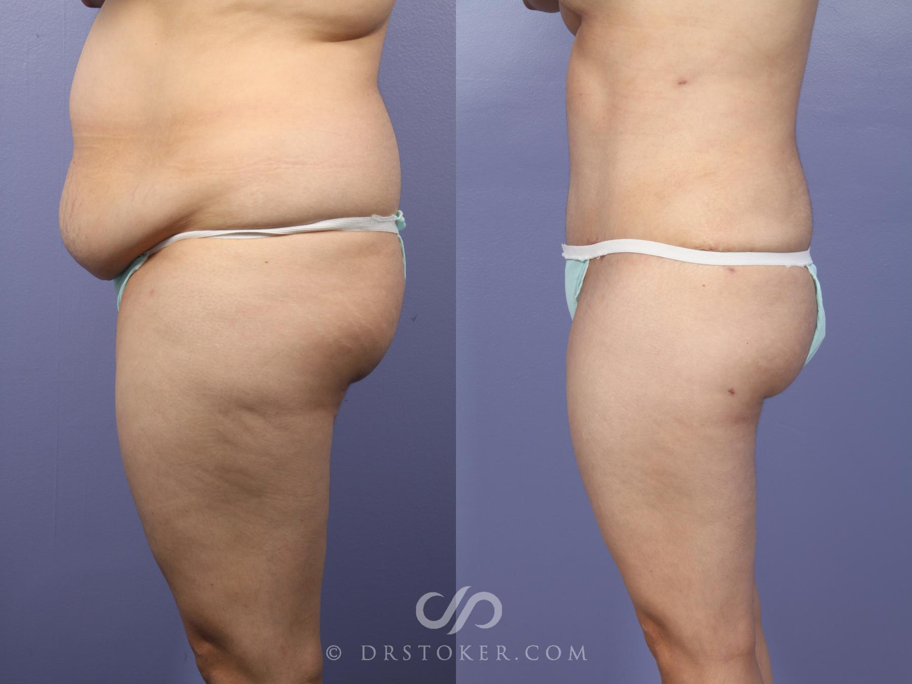 Before & After Liposuction Case 395 View #3 View in Los Angeles, CA