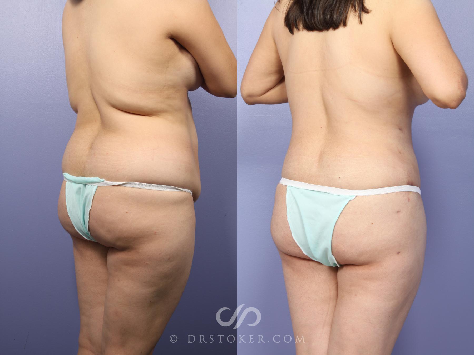 Before & After Liposuction Case 395 View #4 View in Los Angeles, CA