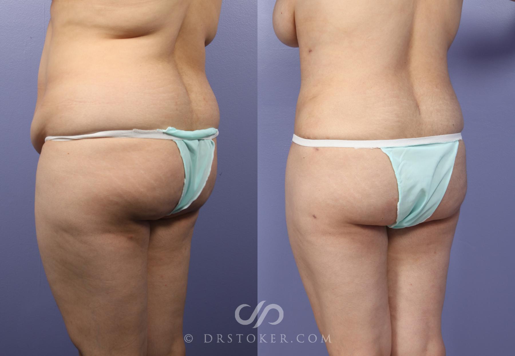 Before & After Tummy Tuck Case 395 View #5 View in Los Angeles, CA