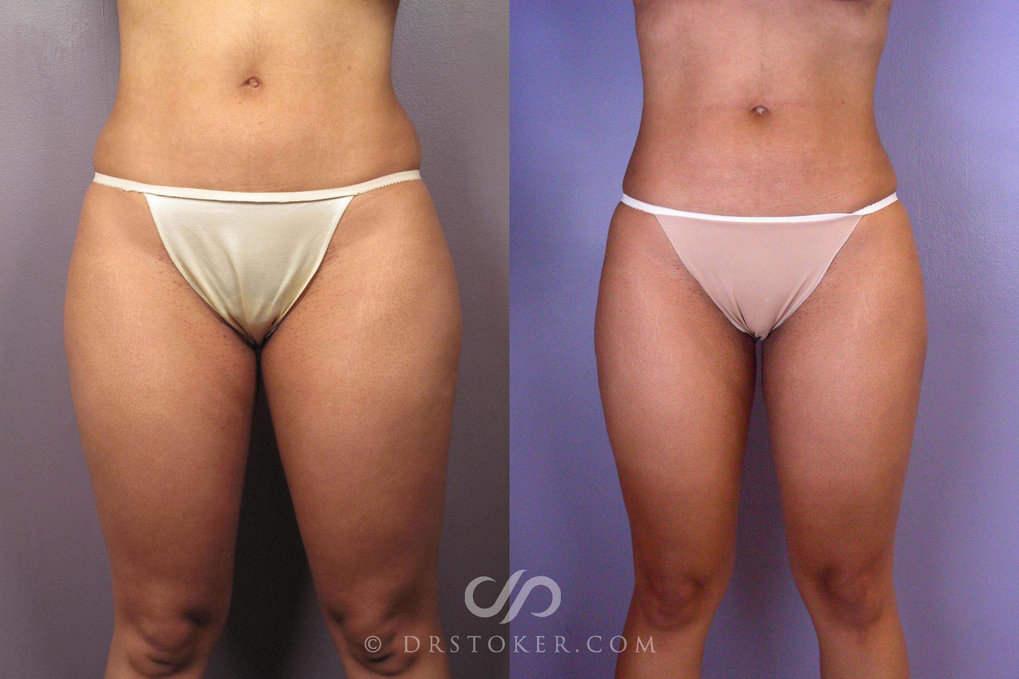 Before & After Liposuction Case 413 View #1 View in Los Angeles, CA