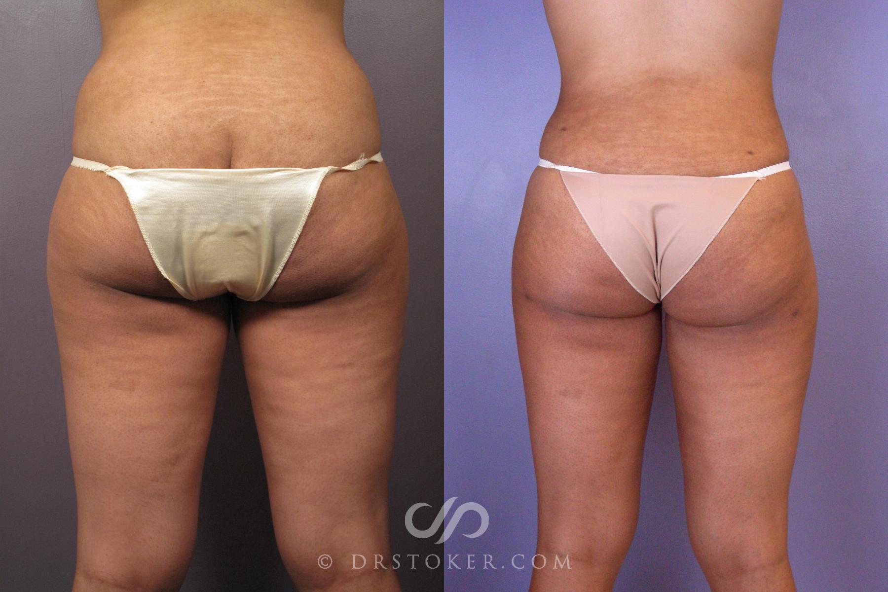 Before & After Liposuction Case 413 View #2 View in Los Angeles, CA
