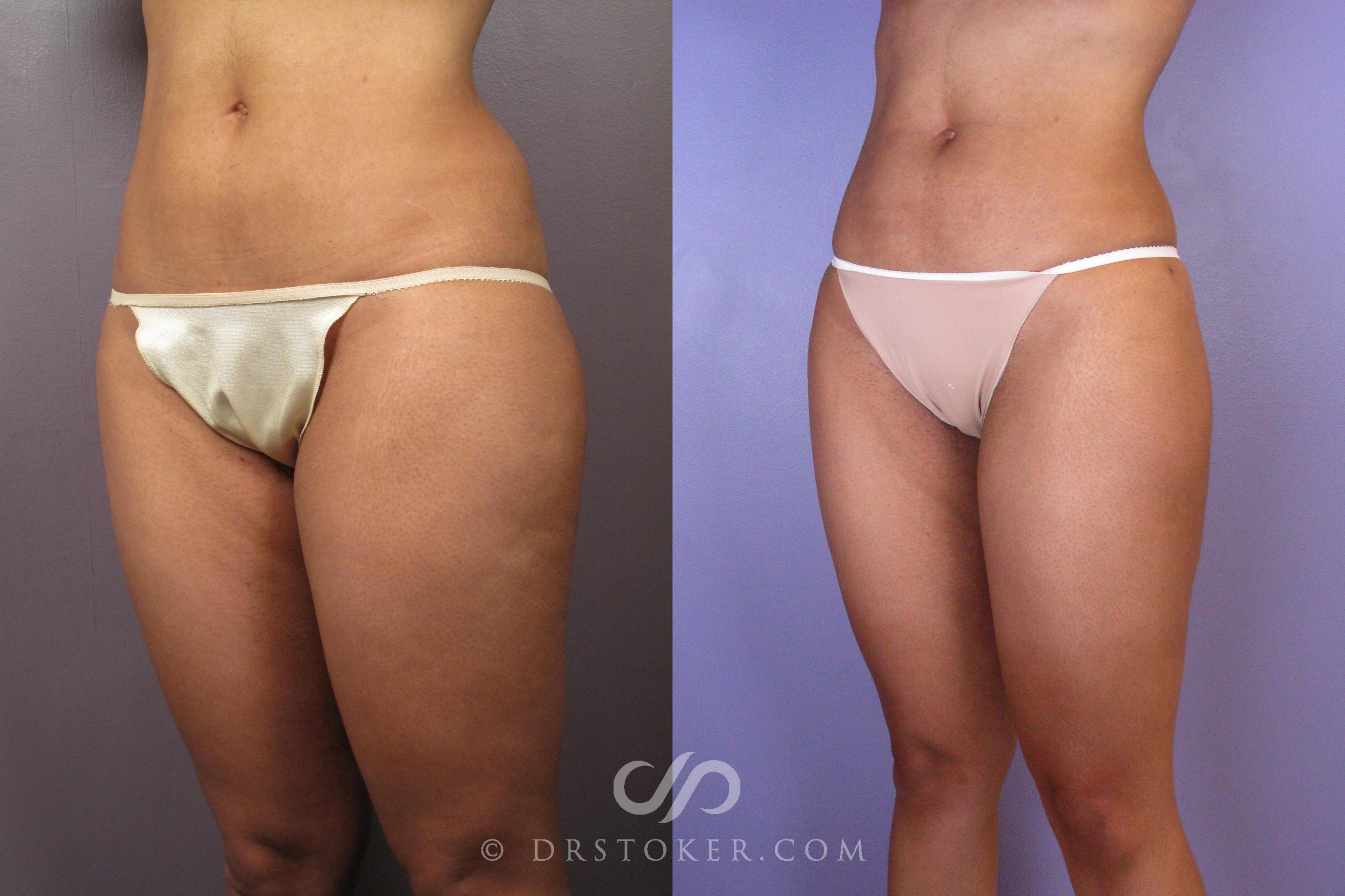 Before & After Liposuction Case 413 View #3 View in Los Angeles, CA