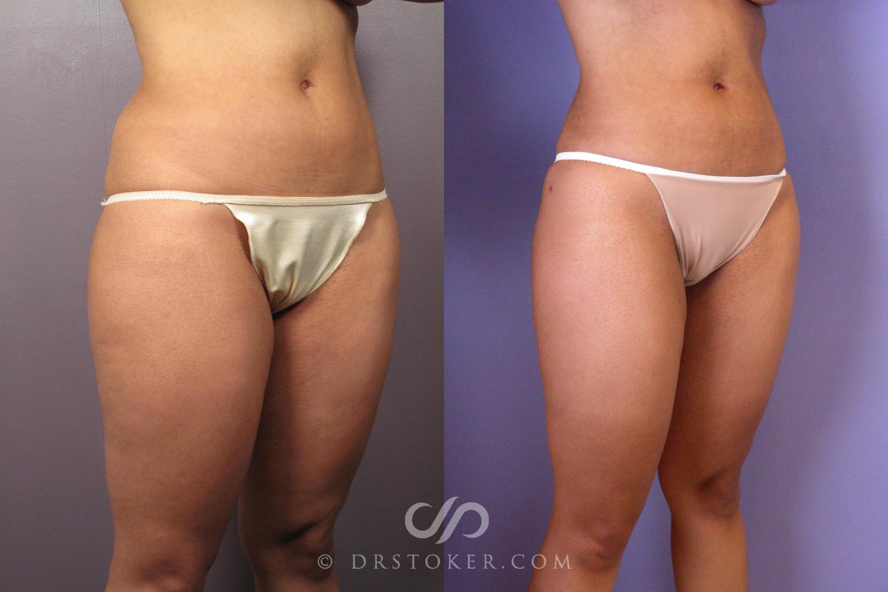 Before & After Liposuction Case 413 View #4 View in Los Angeles, CA