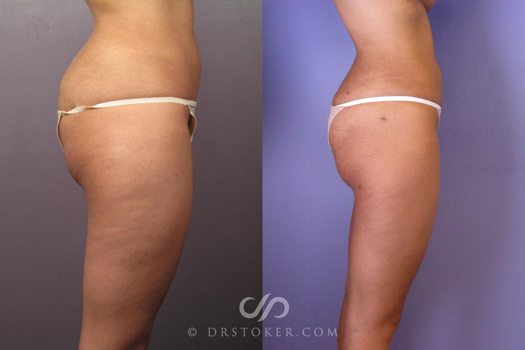 Before & After Liposuction Case 413 View #5 View in Los Angeles, CA