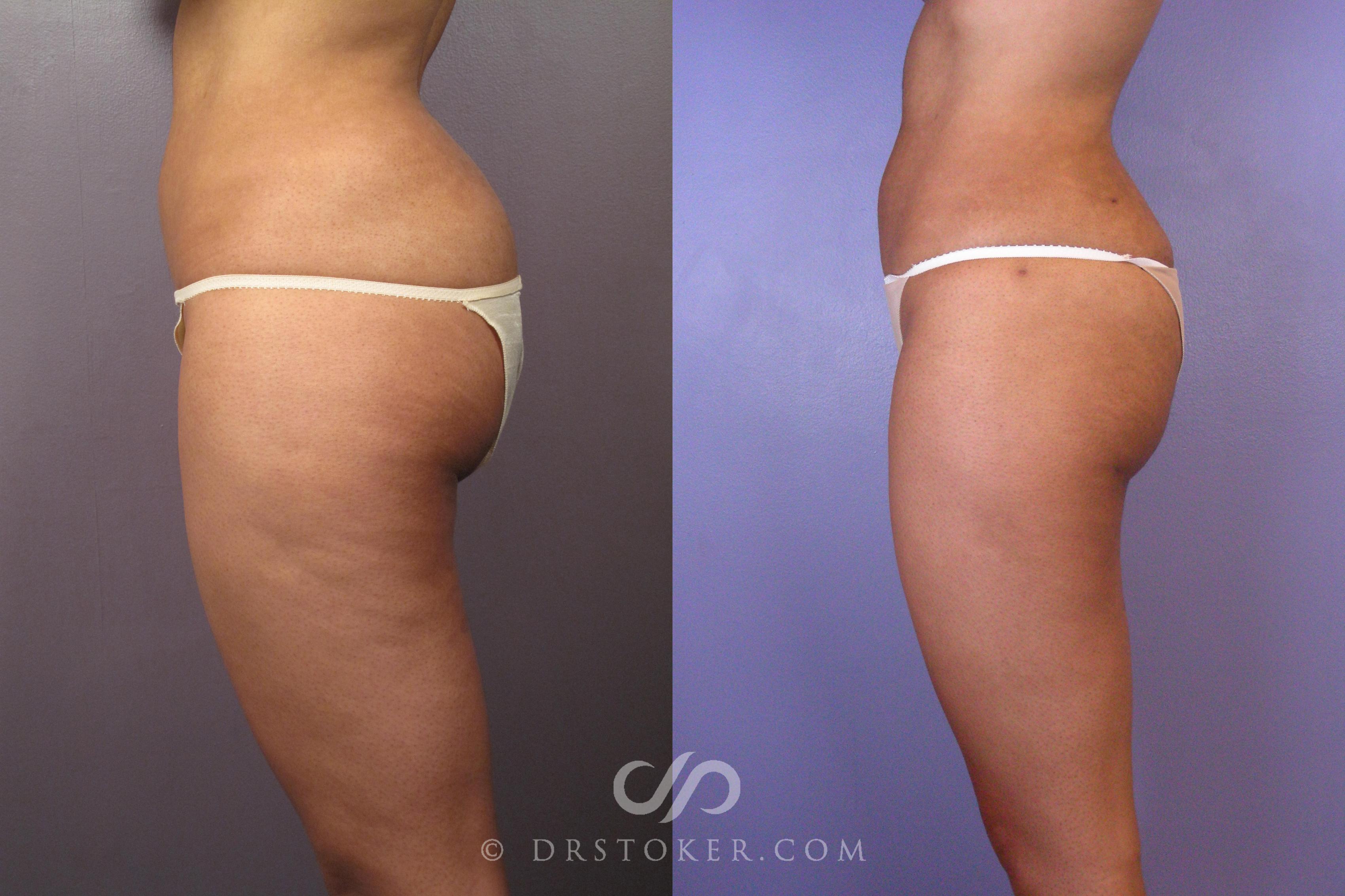 Before & After Liposuction Case 413 View #6 View in Los Angeles, CA