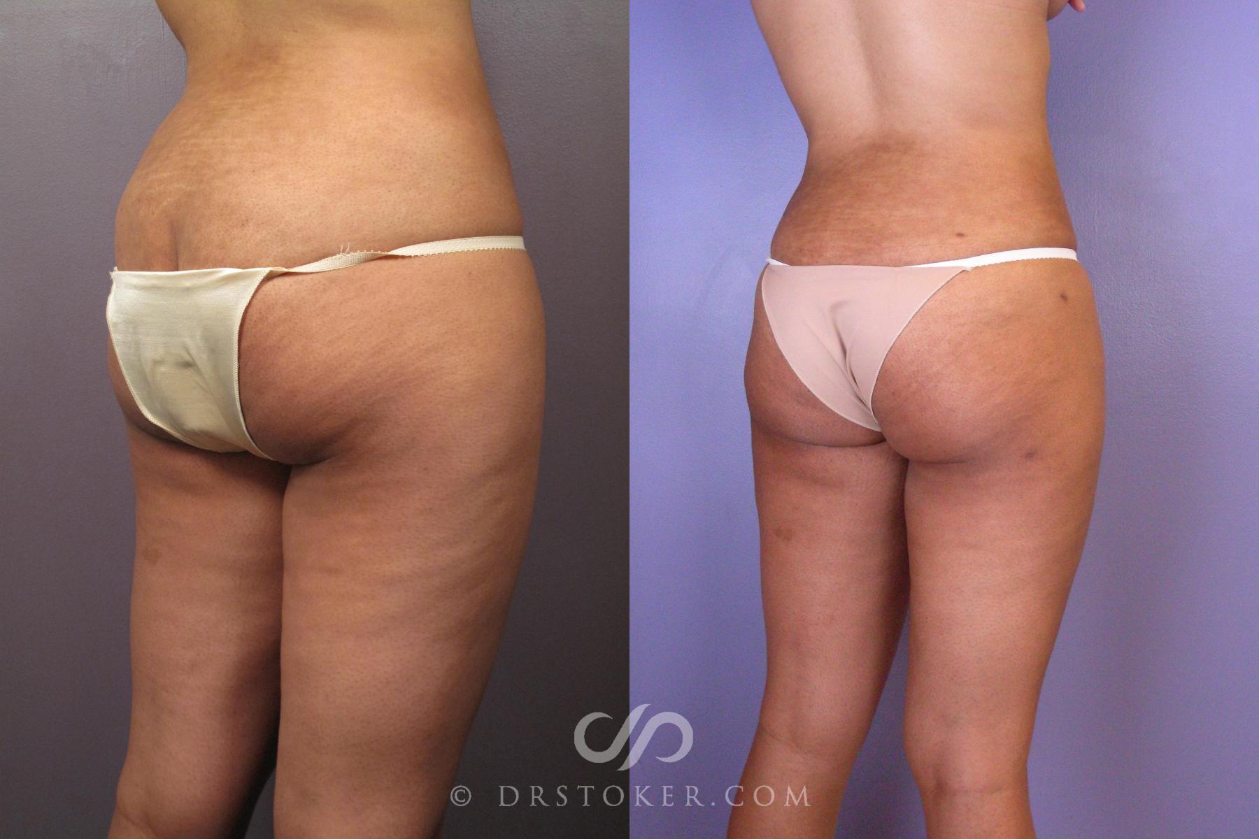 Before & After Liposuction Case 413 View #7 View in Los Angeles, CA