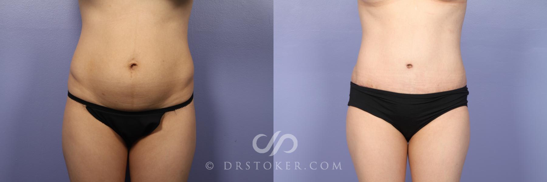 Before & After Liposuction Case 437 View #1 View in Los Angeles, CA