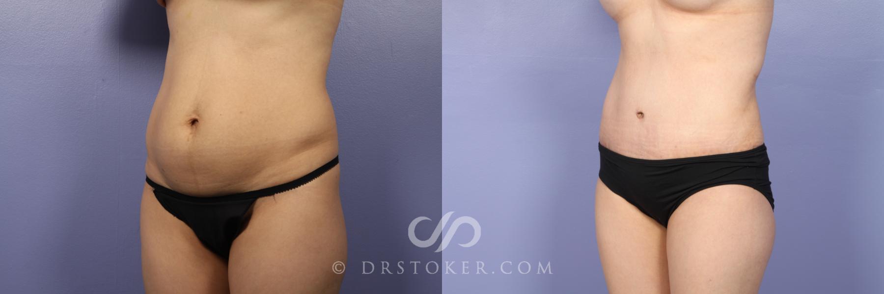 Before & After Liposuction Case 437 View #2 View in Los Angeles, CA