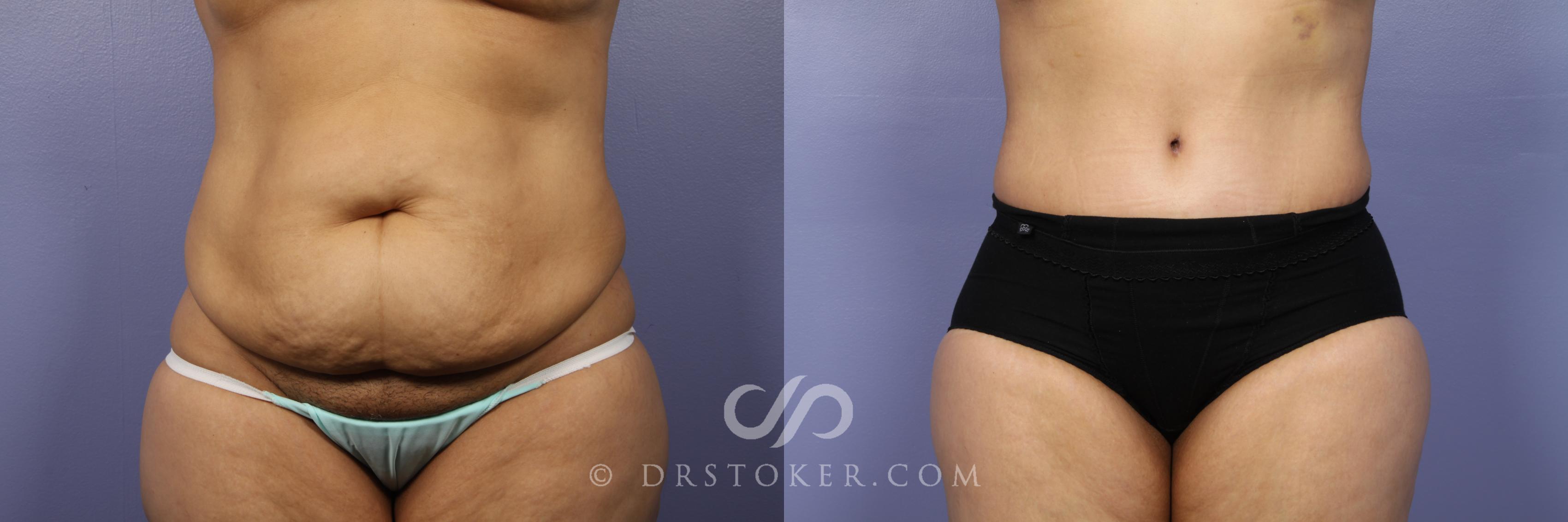 Before & After Tummy Tuck Case 443 View #1 View in Los Angeles, CA