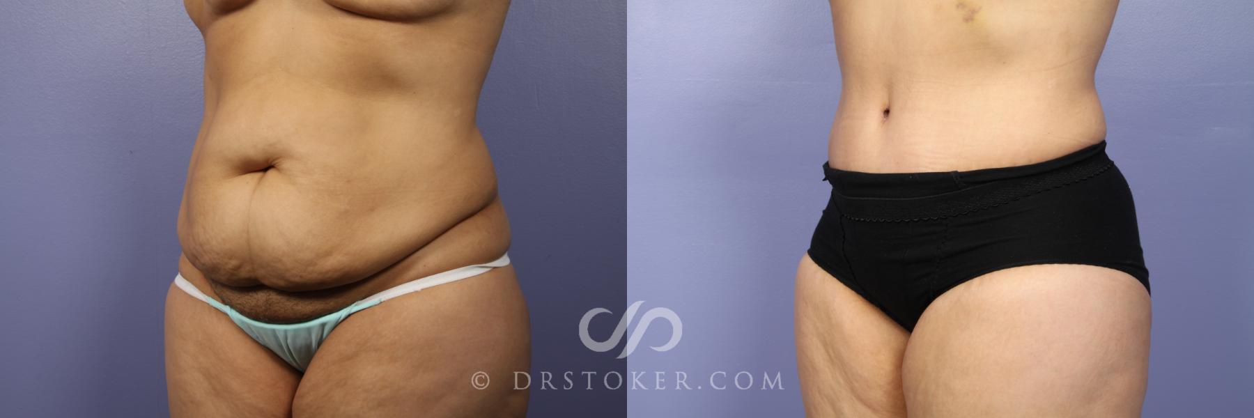 Before & After Tummy Tuck Case 443 View #4 View in Los Angeles, CA