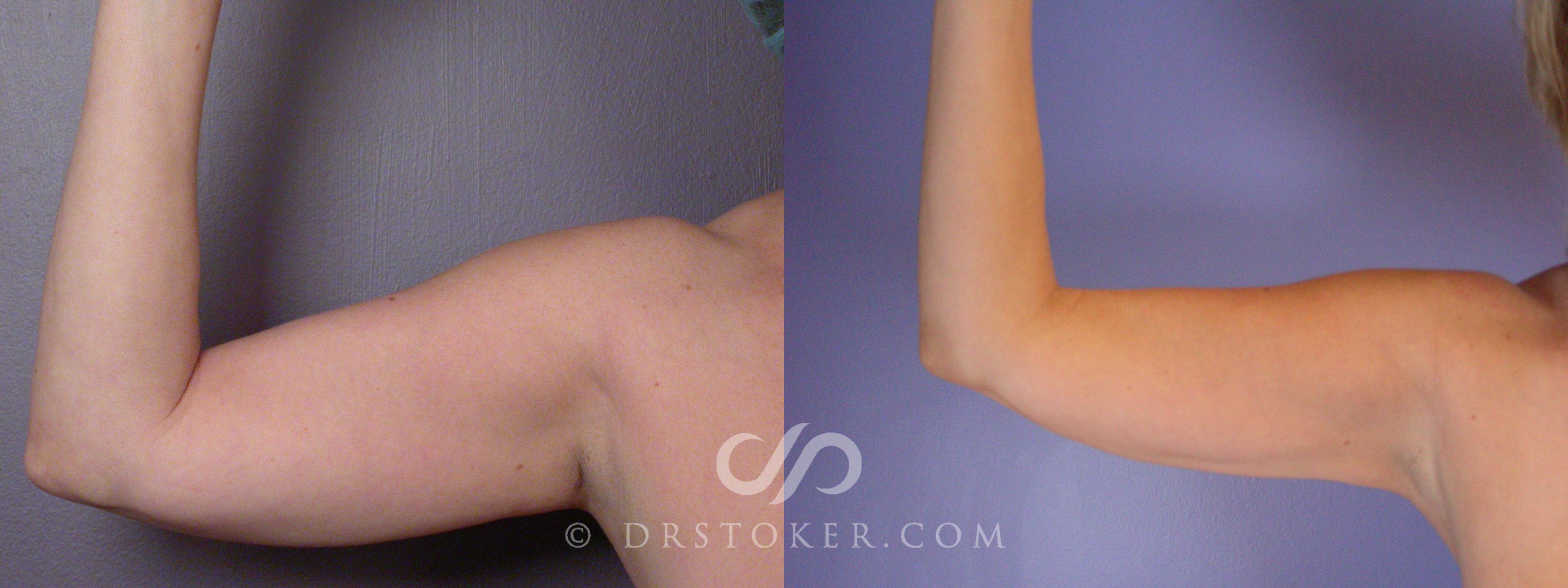 Before & After Liposuction Case 459 View #1 View in Los Angeles, CA
