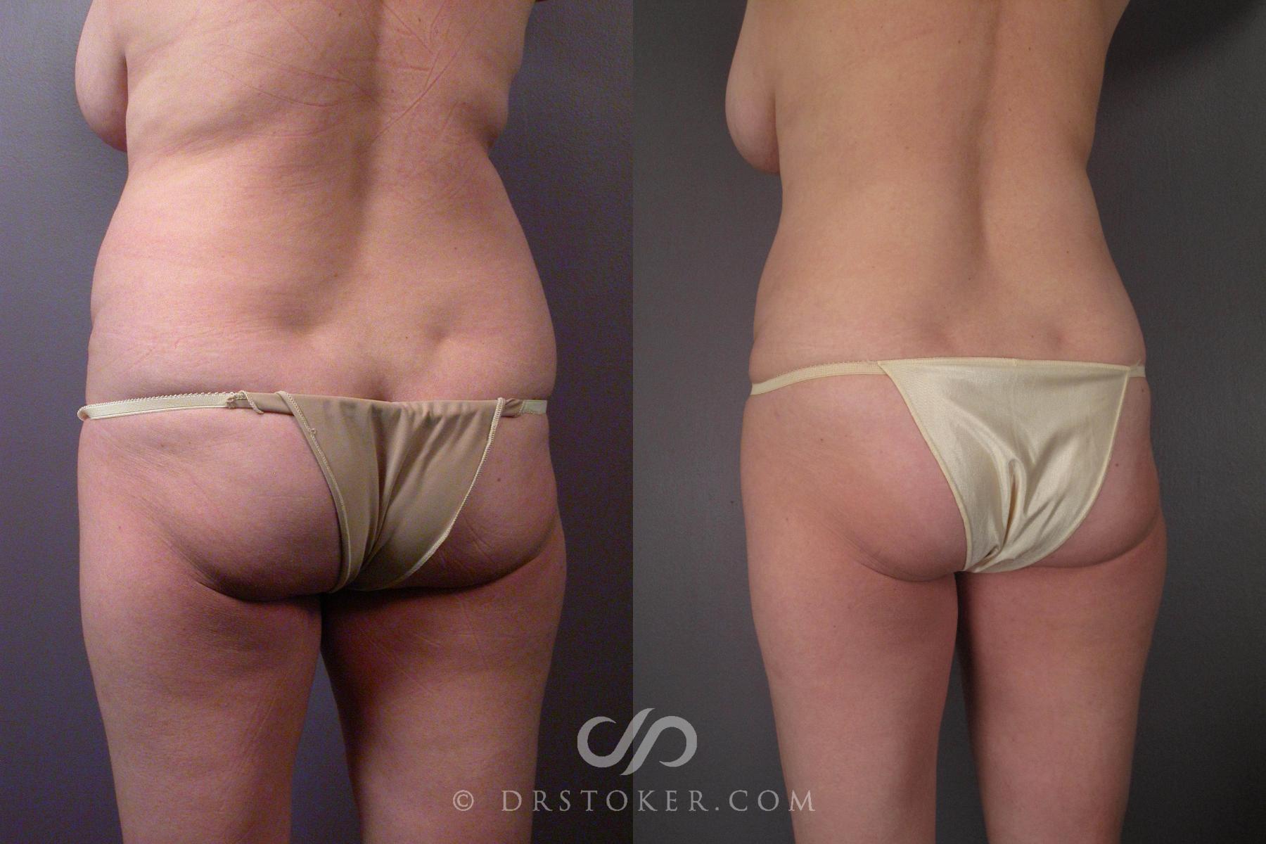 Before & After Liposuction Case 459 View #10 View in Los Angeles, CA