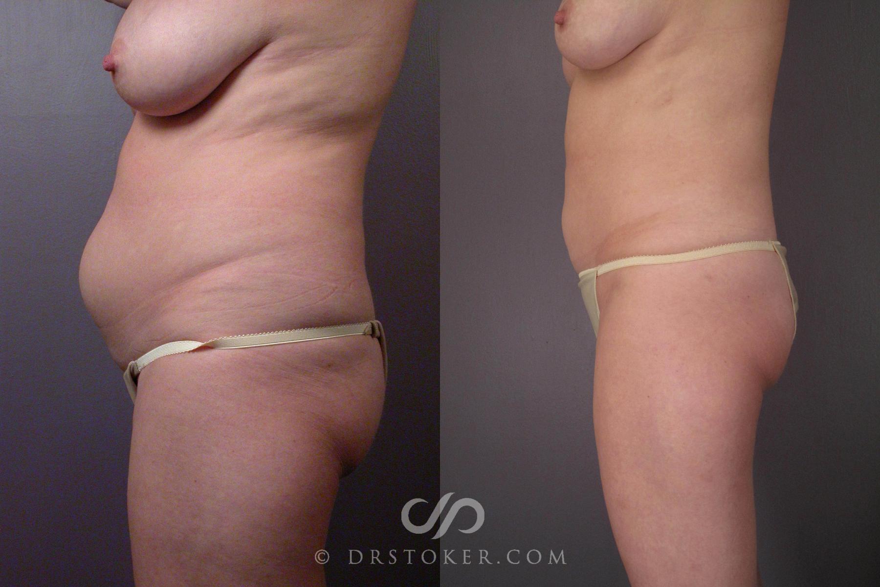 Before & After Liposuction Case 459 View #11 View in Los Angeles, CA