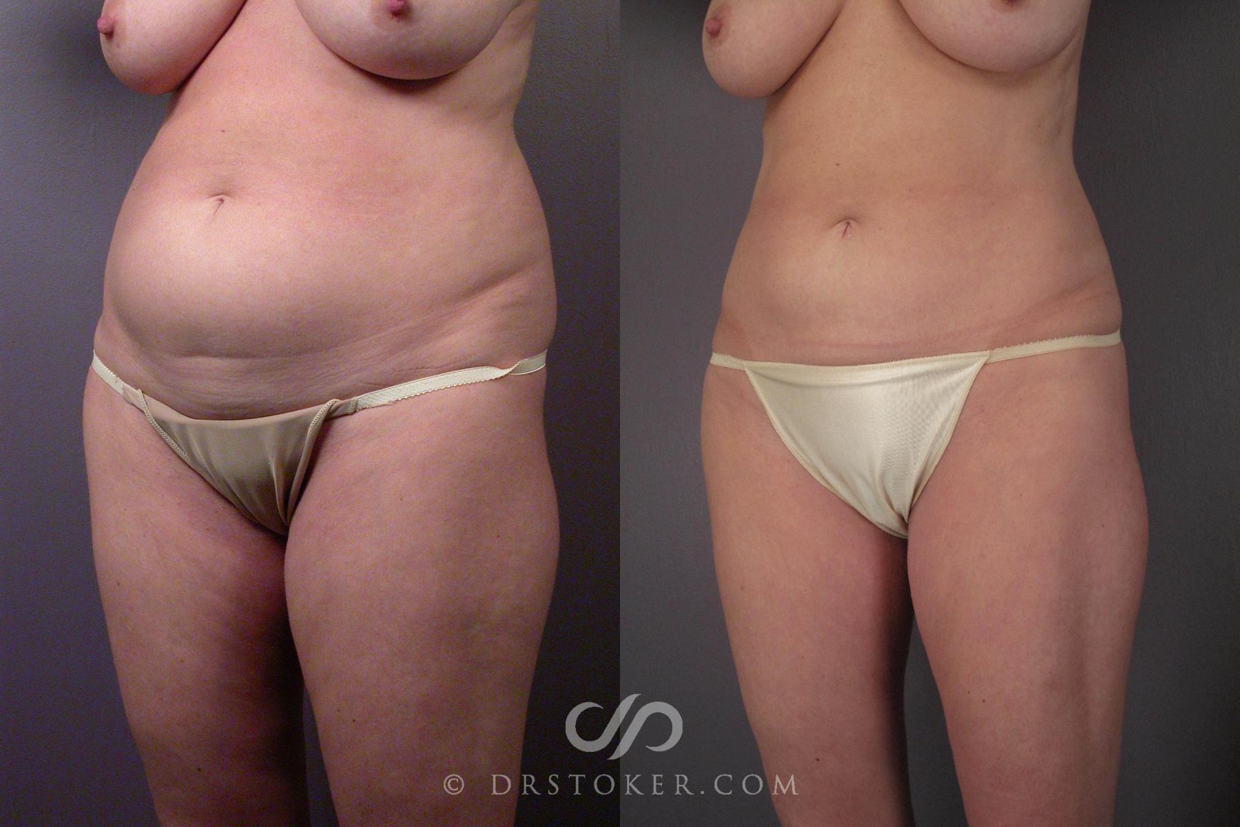 Before & After Liposuction Case 459 View #12 View in Los Angeles, CA