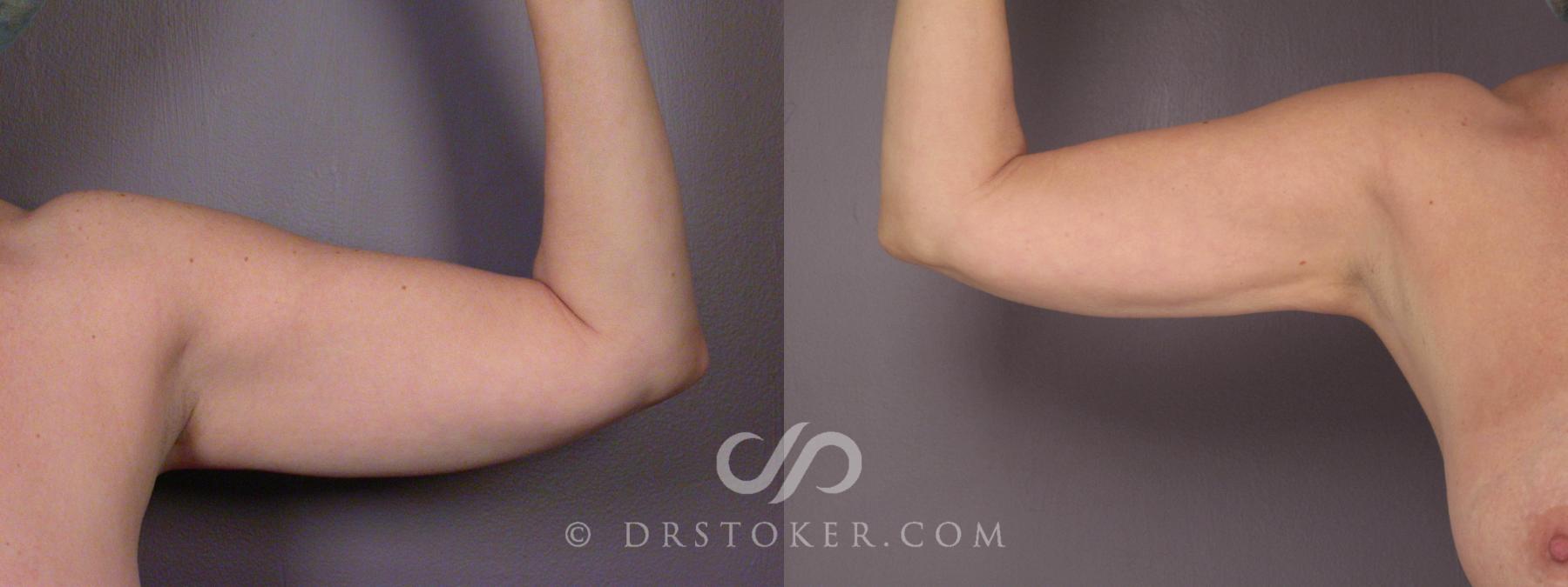 Before & After Liposuction Case 459 View #2 View in Los Angeles, CA
