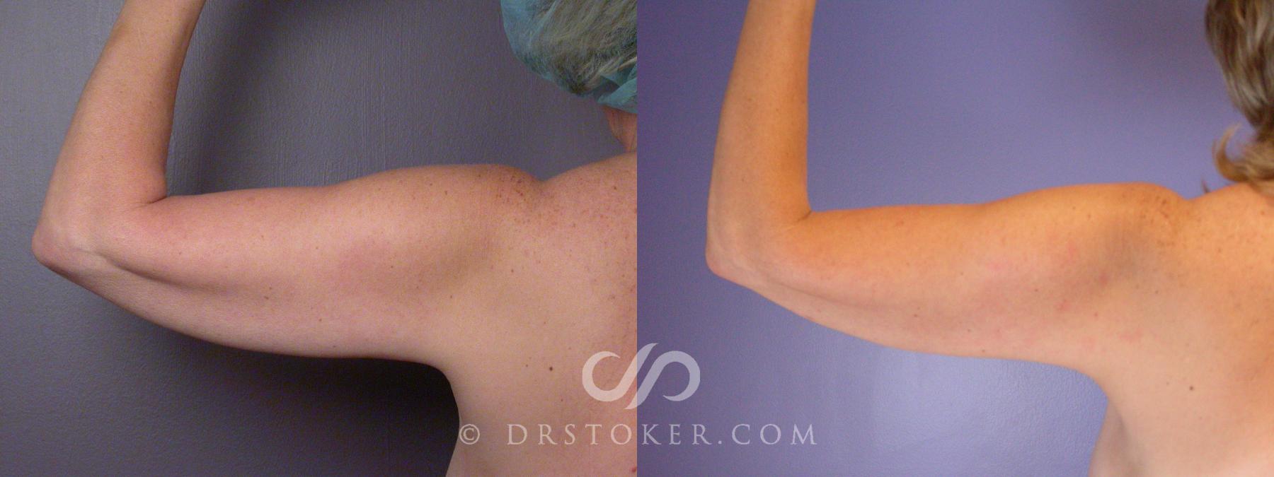 Before & After Liposuction Case 459 View #3 View in Los Angeles, CA