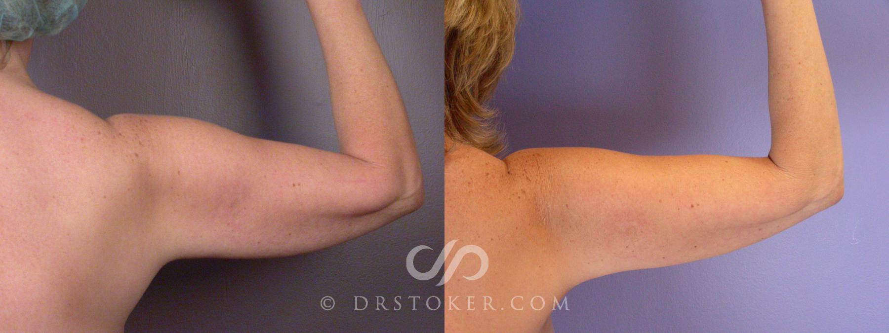 Before & After Liposuction Case 459 View #4 View in Los Angeles, CA