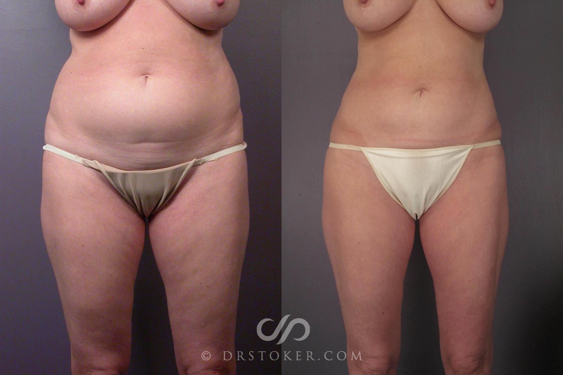Before & After Liposuction Case 459 View #5 View in Los Angeles, CA