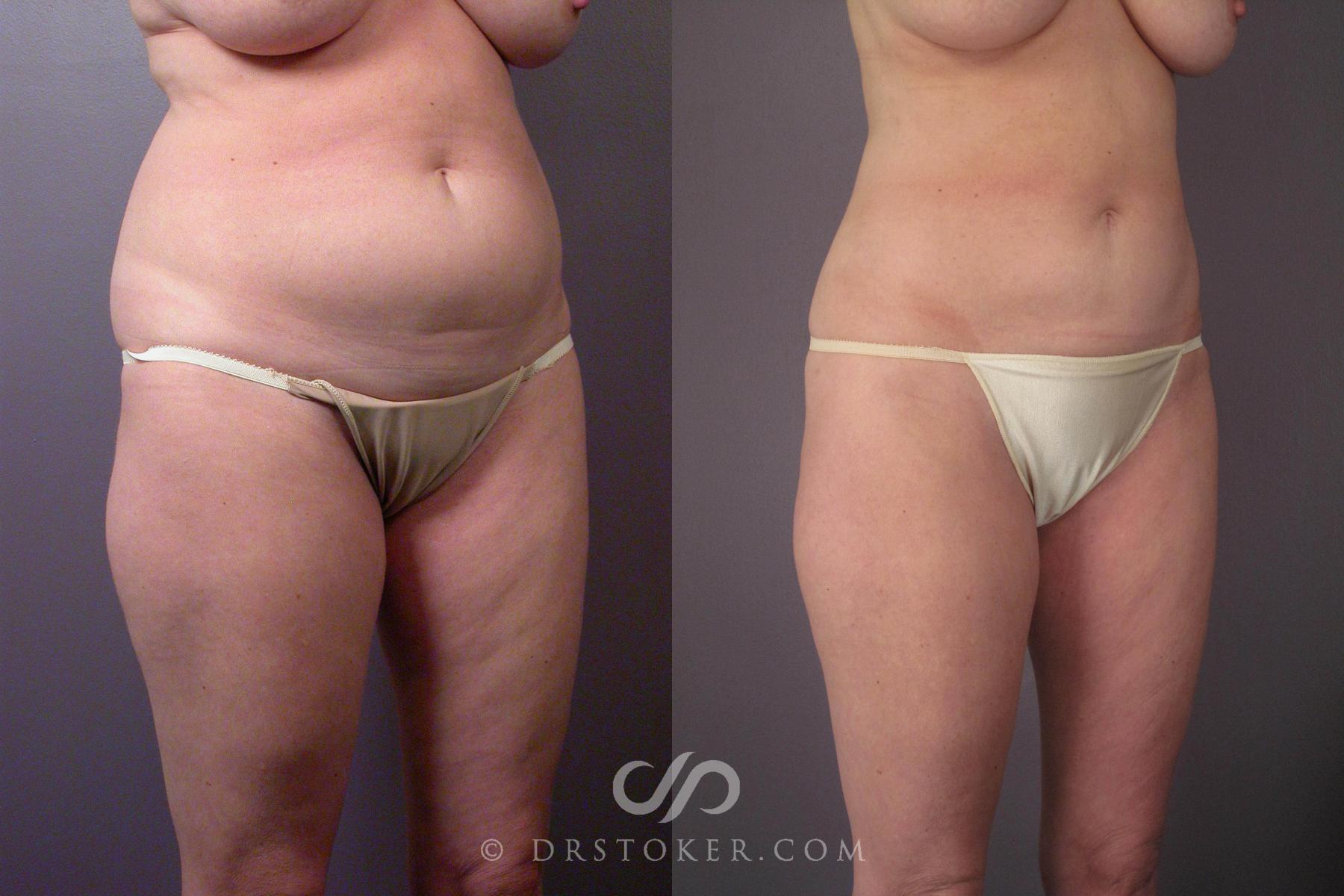 Before & After Liposuction Case 459 View #6 View in Los Angeles, CA