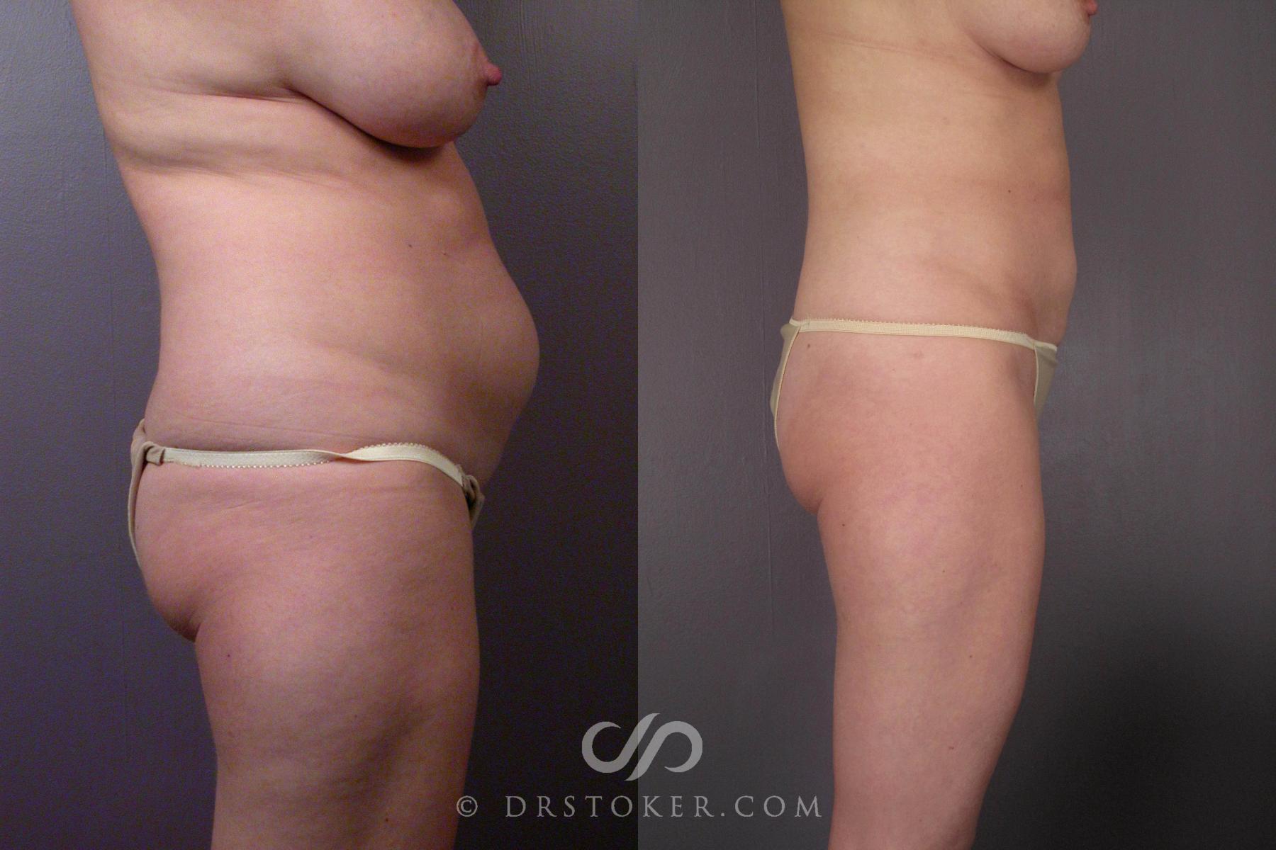Before & After Liposuction Case 459 View #7 View in Los Angeles, CA