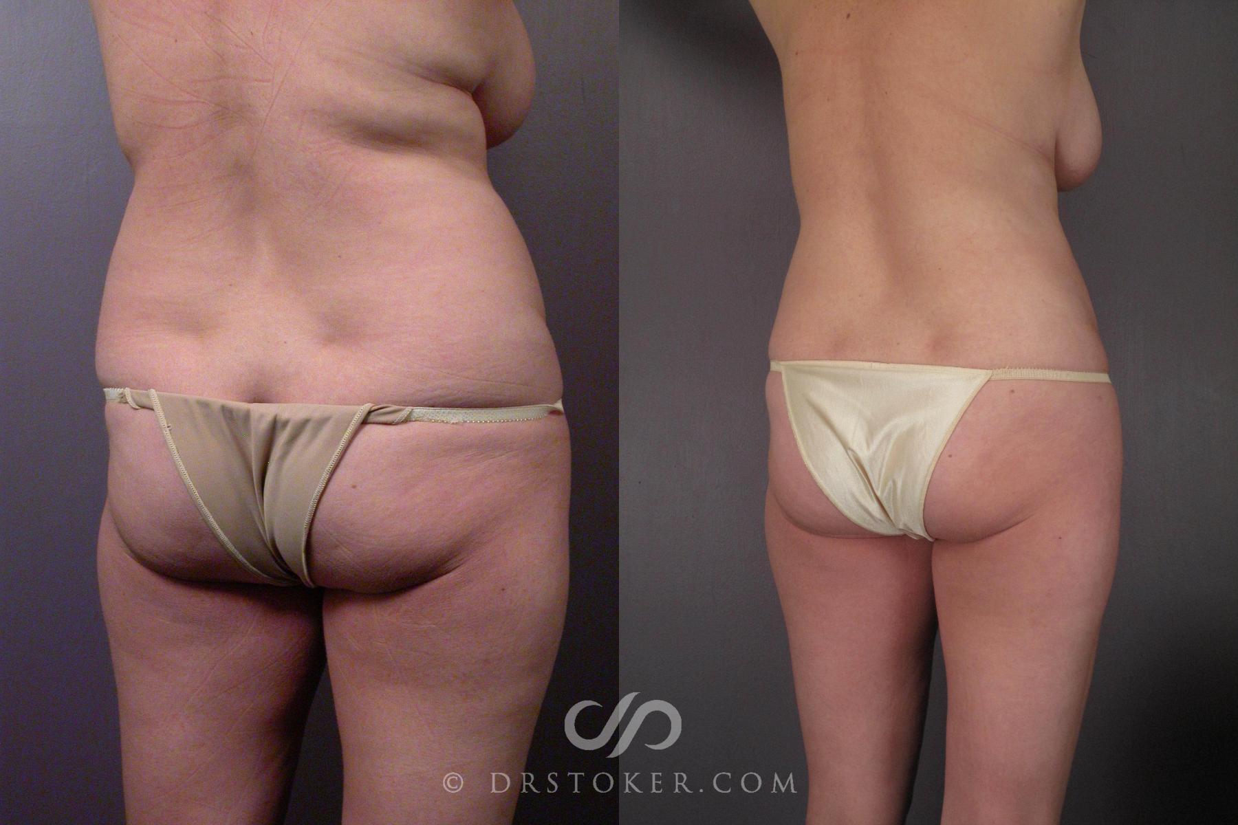 Before & After Liposuction Case 459 View #8 View in Los Angeles, CA