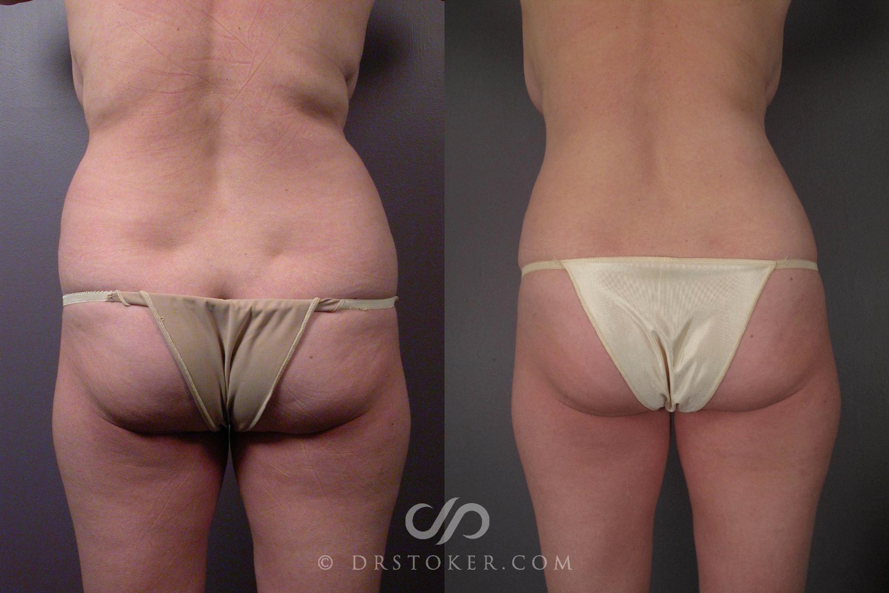 Before & After Liposuction Case 459 View #9 View in Los Angeles, CA