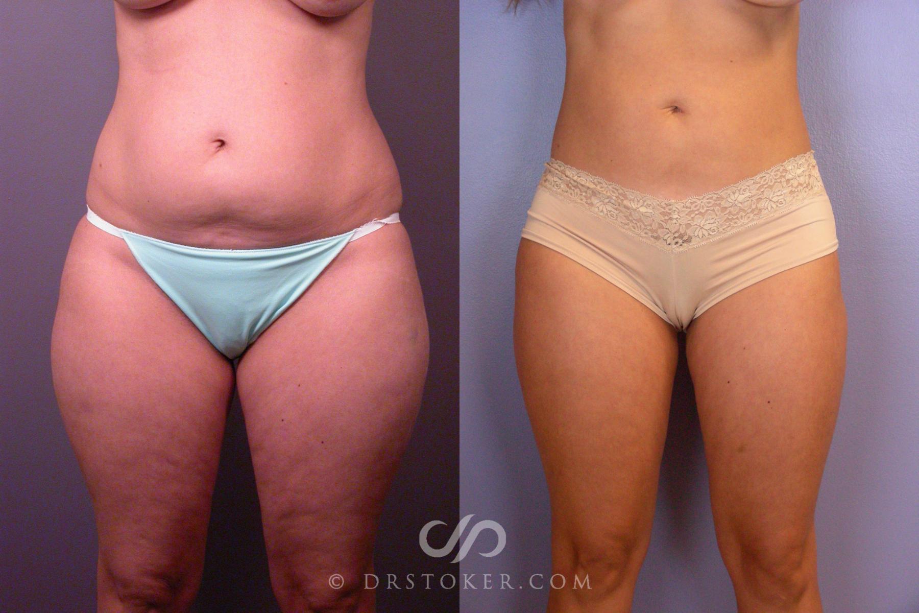 Before & After Liposuction Case 460 View #1 View in Los Angeles, CA