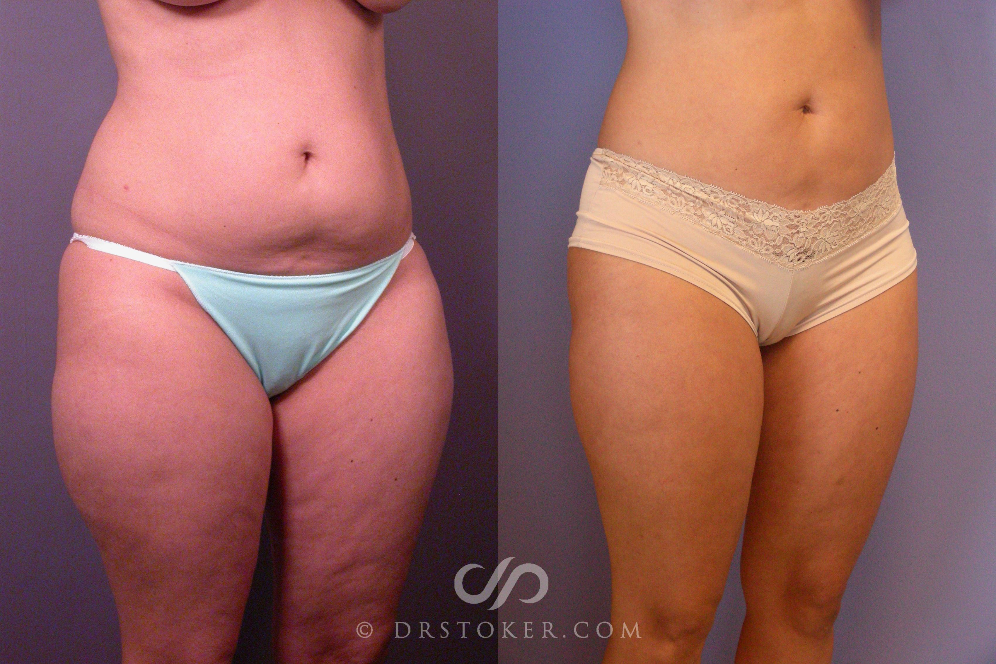 Before & After Liposuction Case 460 View #2 View in Los Angeles, CA