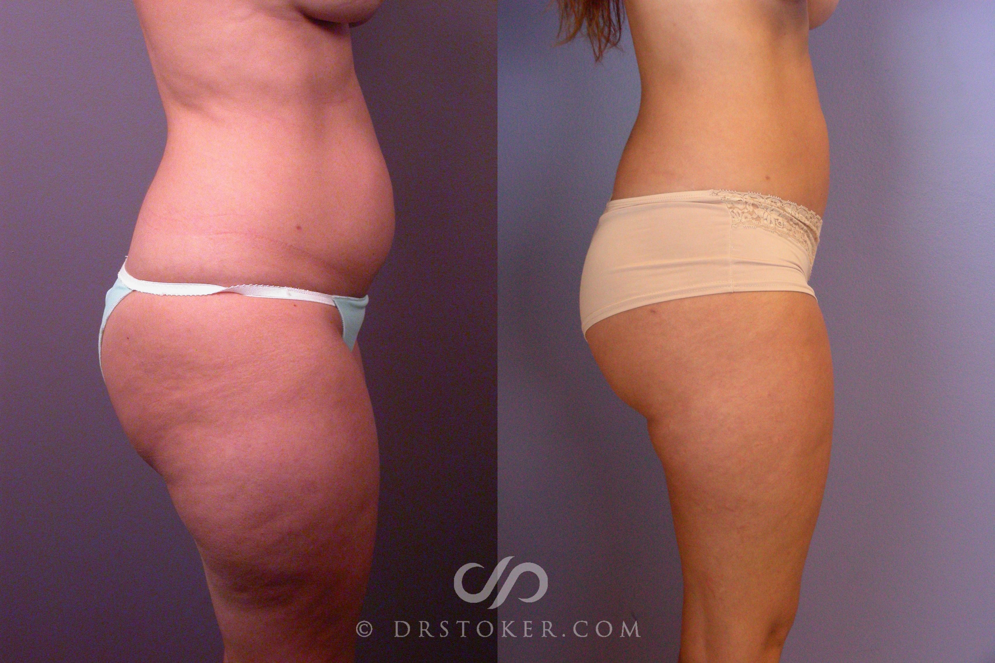 Before & After Liposuction Case 460 View #3 View in Los Angeles, CA