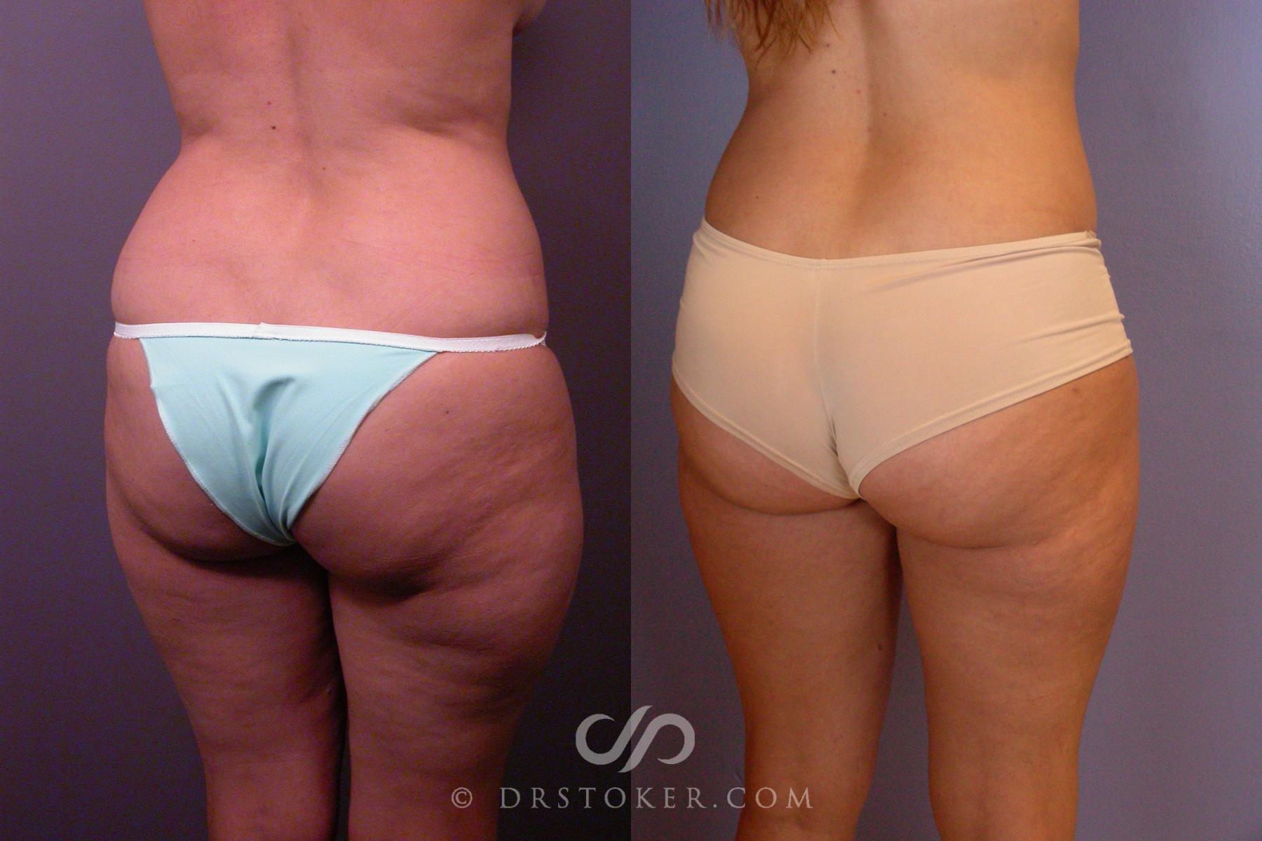 Before & After Liposuction Case 460 View #4 View in Los Angeles, CA
