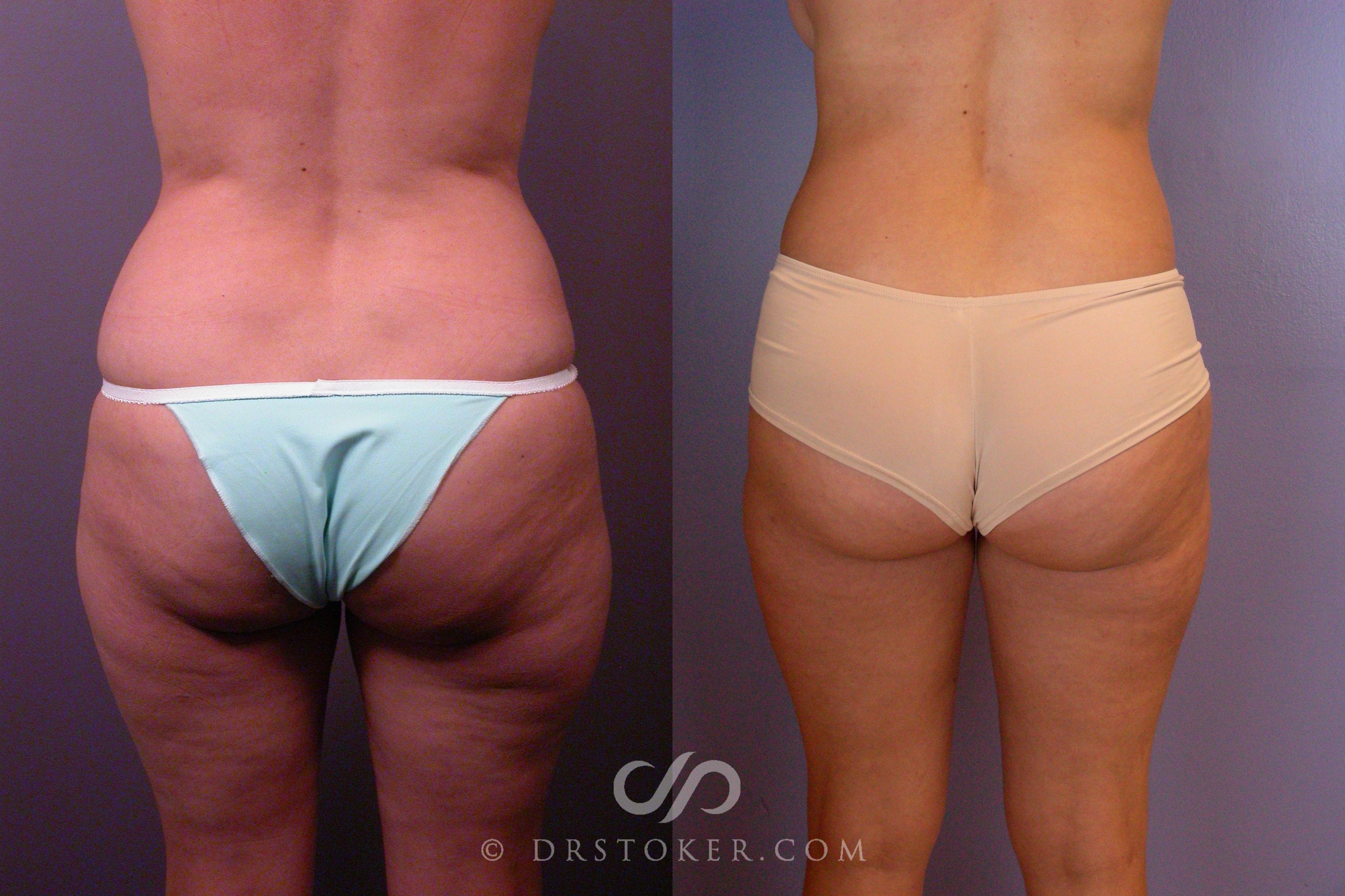 Before & After Liposuction Case 460 View #5 View in Los Angeles, CA