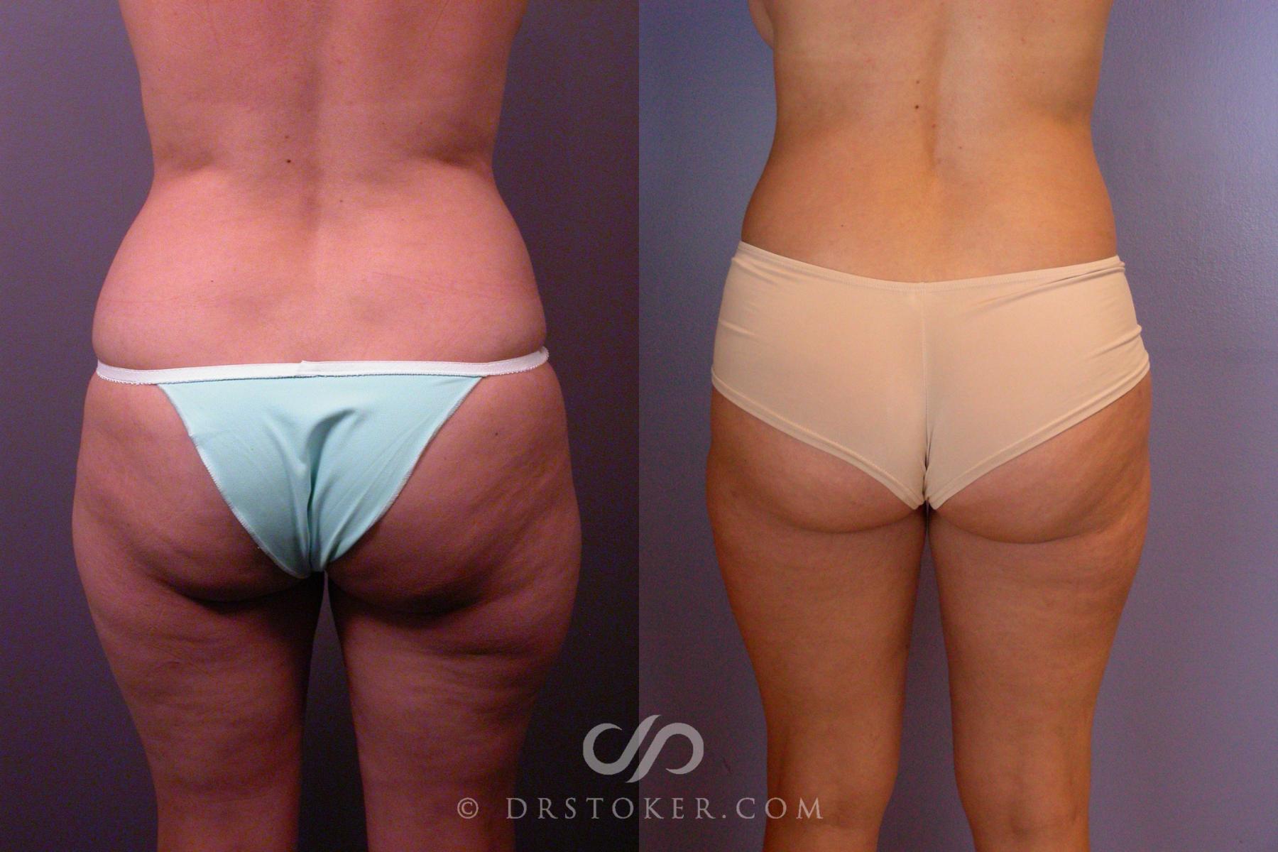 Before & After Liposuction Case 460 View #5 View in Los Angeles, CA