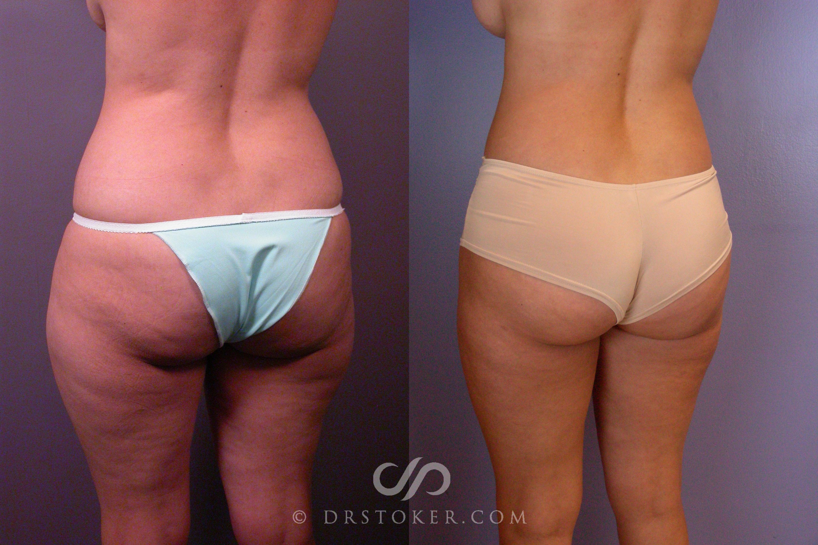 Before & After Liposuction Case 460 View #6 View in Los Angeles, CA