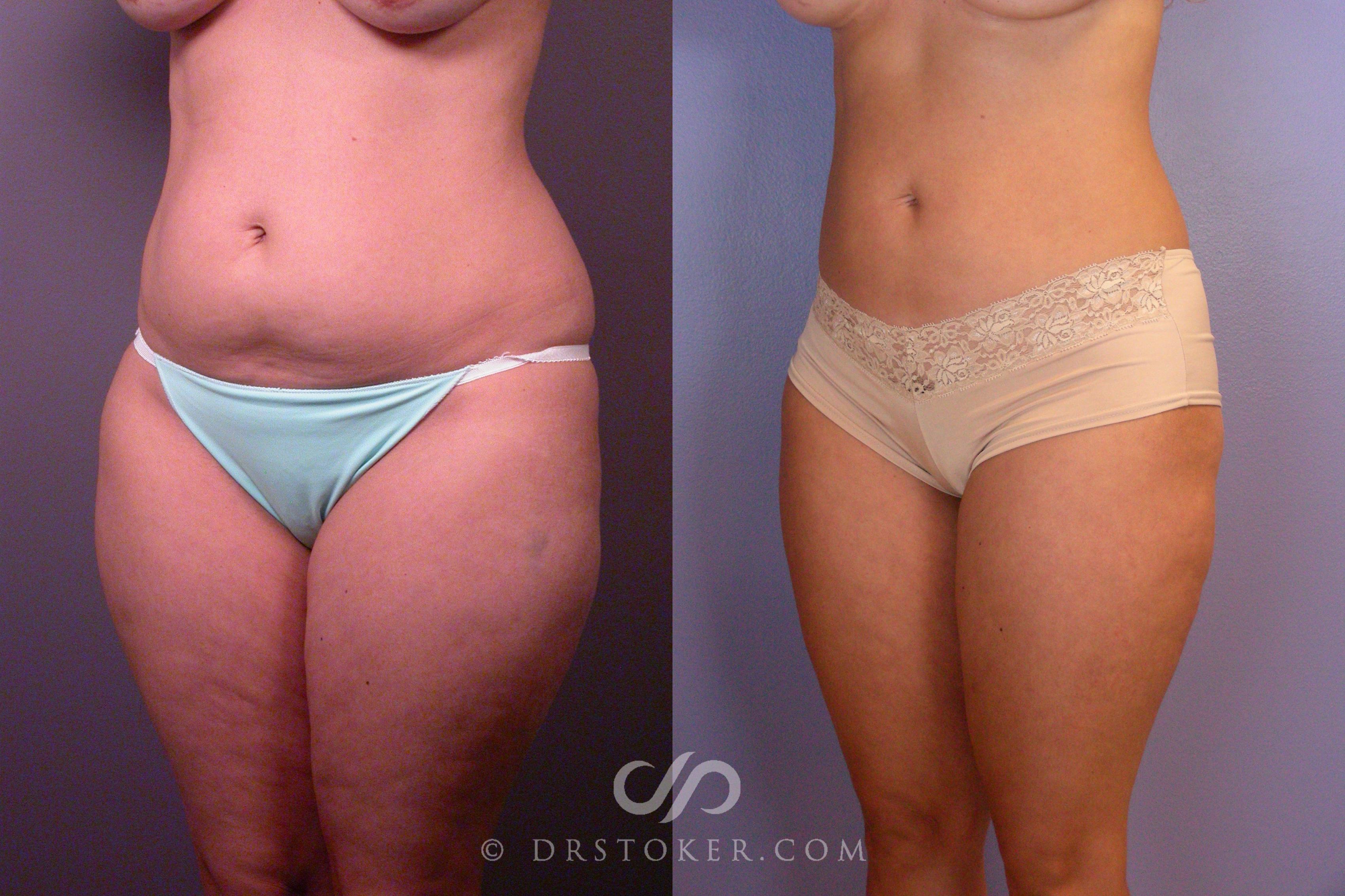 Before & After Liposuction Case 460 View #7 View in Los Angeles, CA