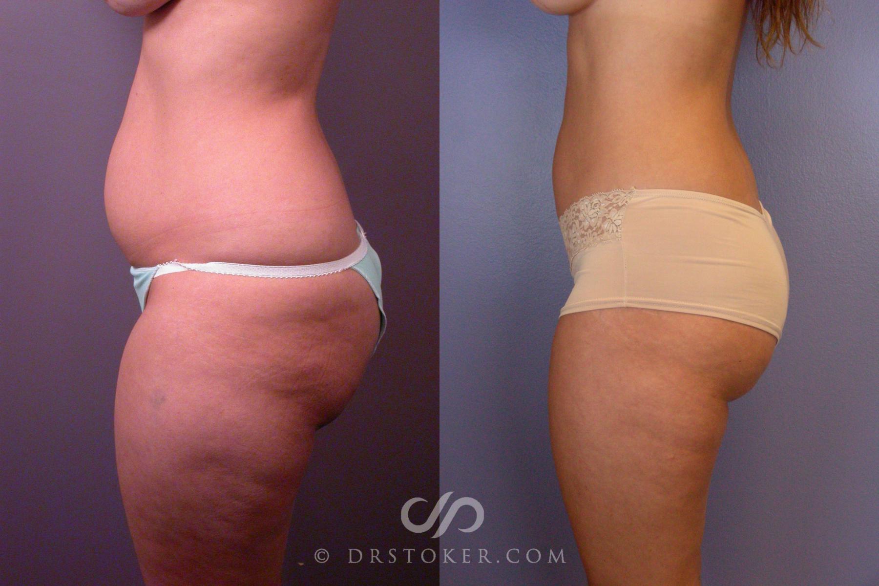 Before & After Liposuction Case 460 View #8 View in Los Angeles, CA