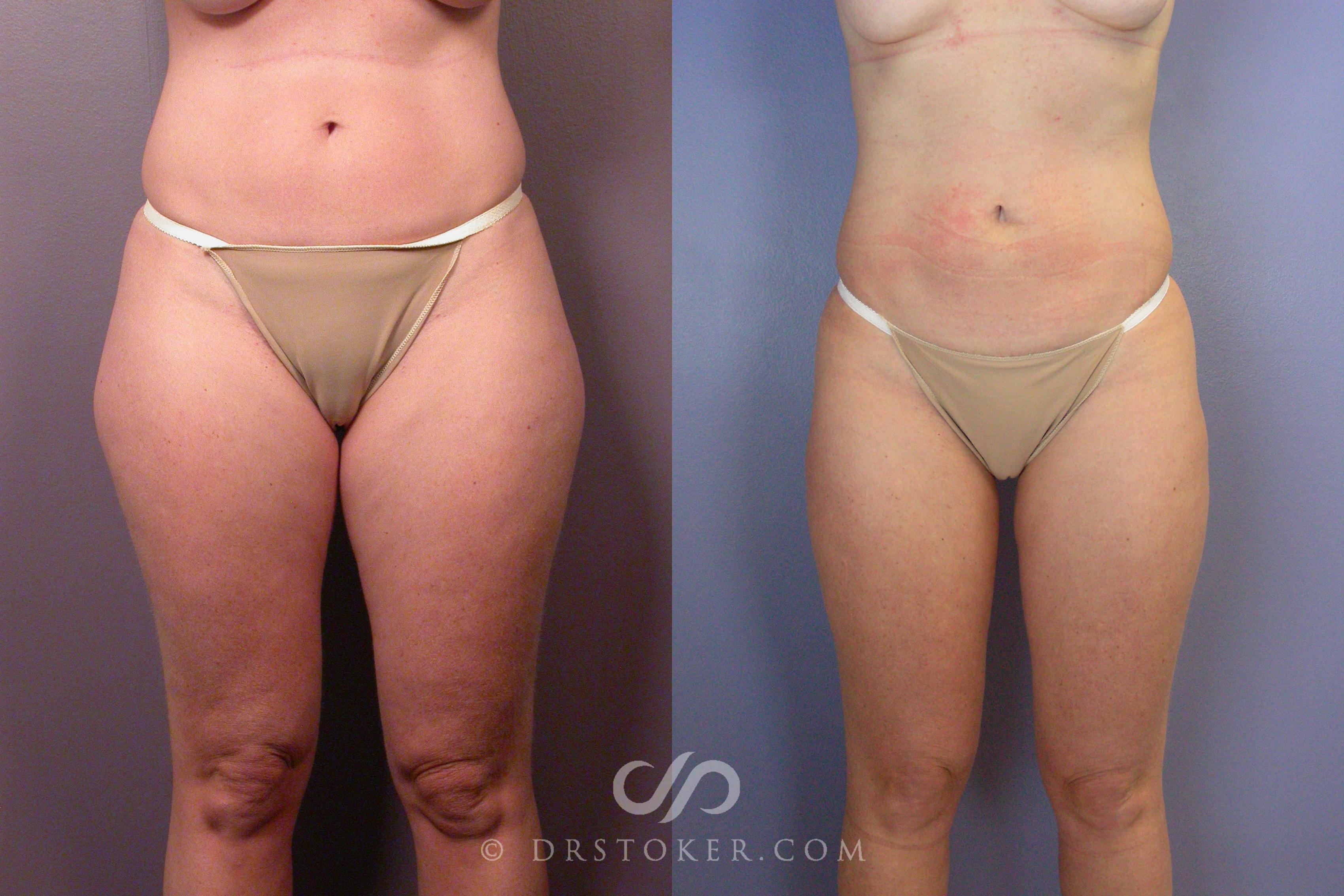 Before & After Liposuction Case 461 View #1 View in Los Angeles, CA
