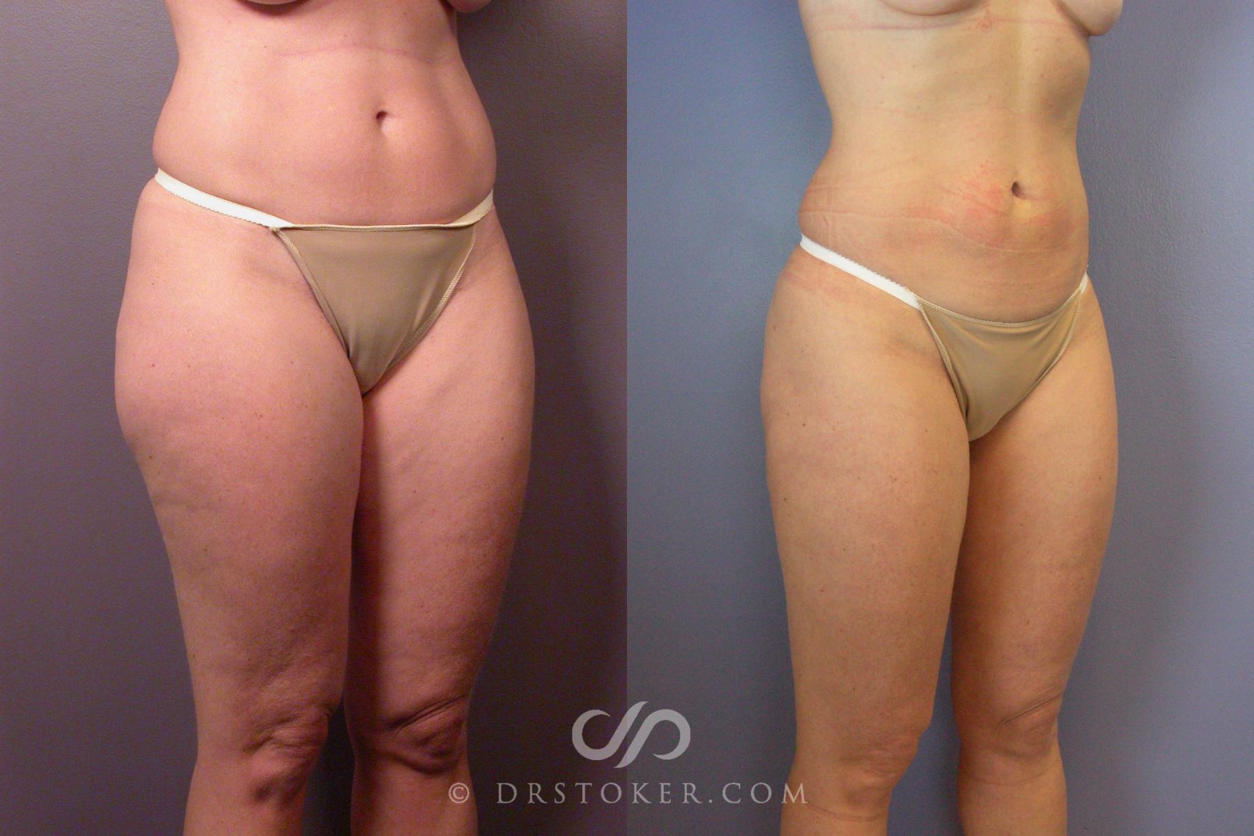 Before & After Liposuction Case 461 View #2 View in Los Angeles, CA