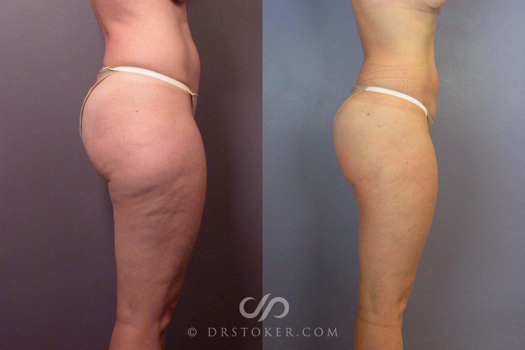 Before & After Liposuction Case 461 View #3 View in Los Angeles, CA