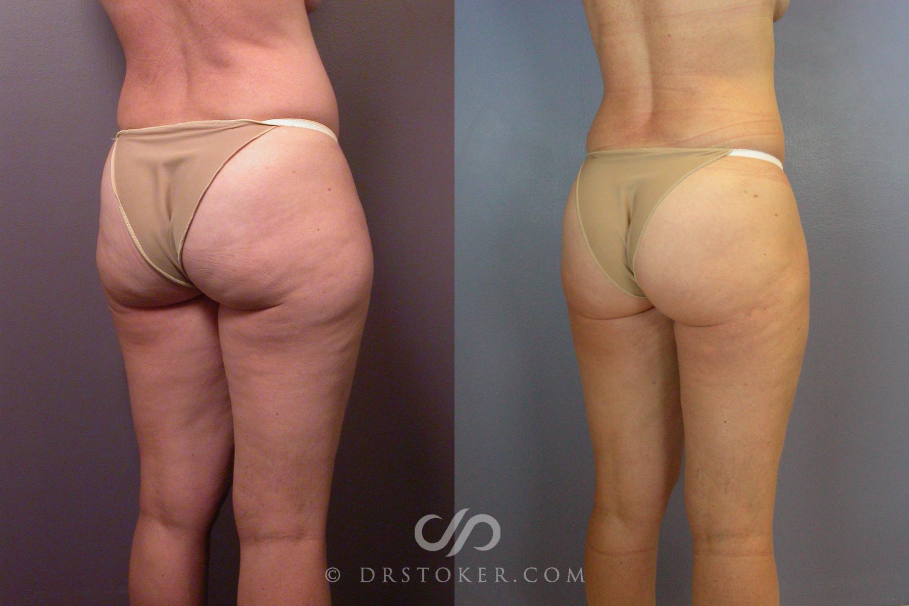 Before & After Liposuction Case 461 View #4 View in Los Angeles, CA
