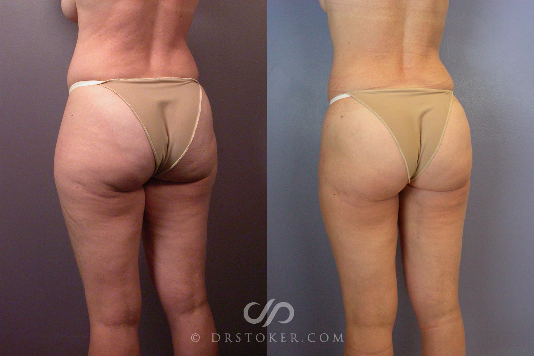 Before & After Liposuction Case 461 View #5 View in Los Angeles, CA