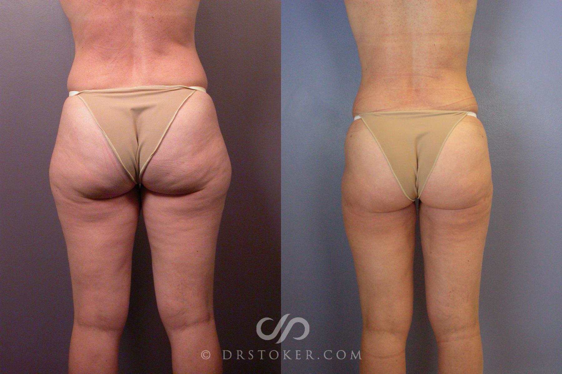 Before & After Liposuction Case 461 View #6 View in Los Angeles, CA