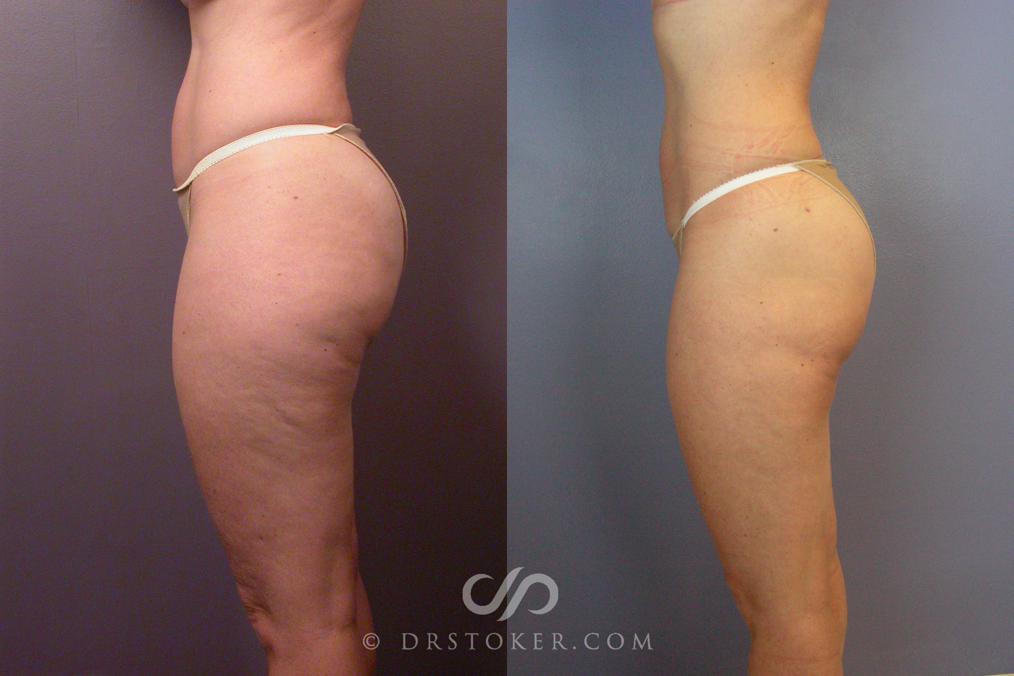 Before & After Liposuction Case 461 View #7 View in Los Angeles, CA