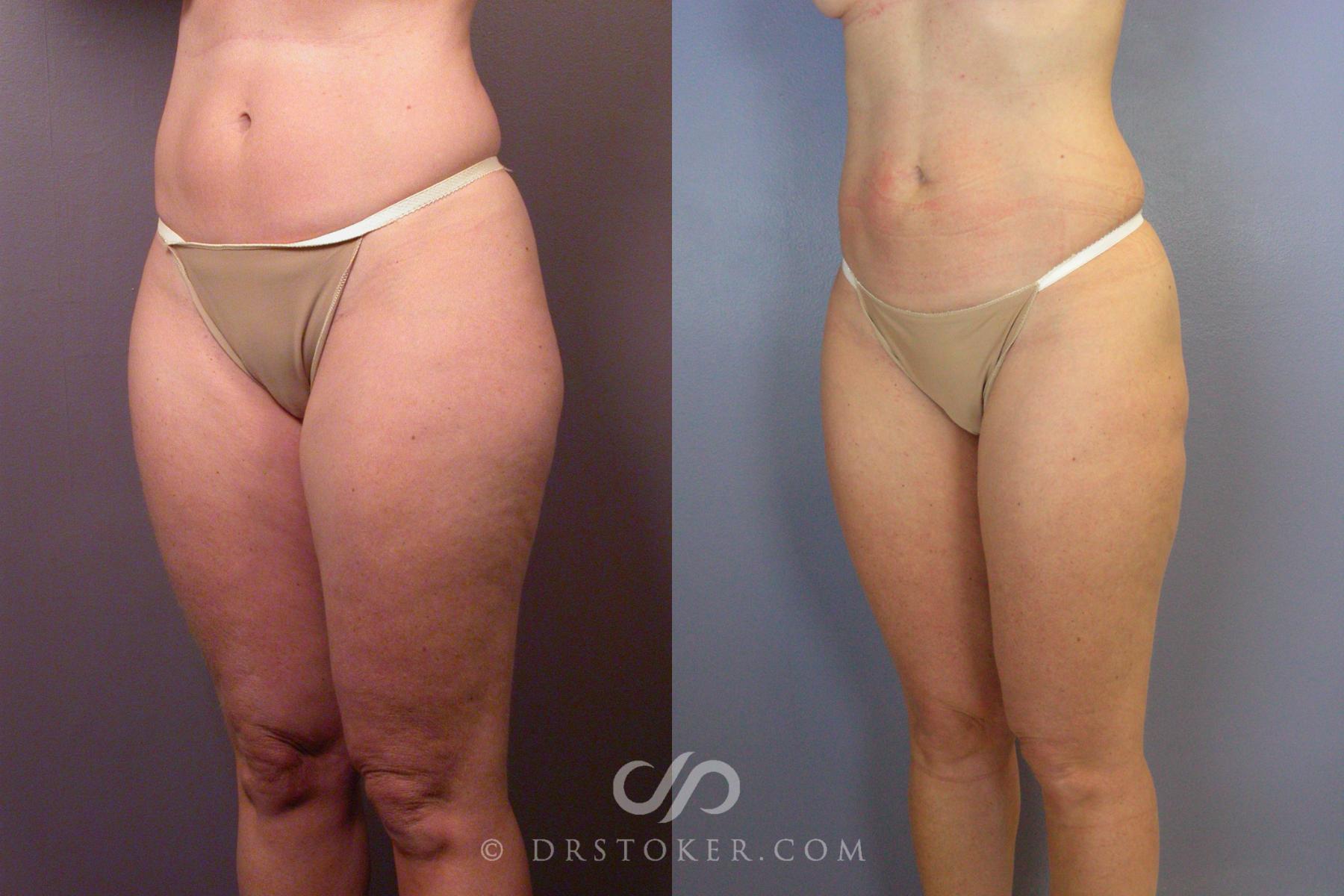 Before & After Liposuction Case 461 View #8 View in Los Angeles, CA